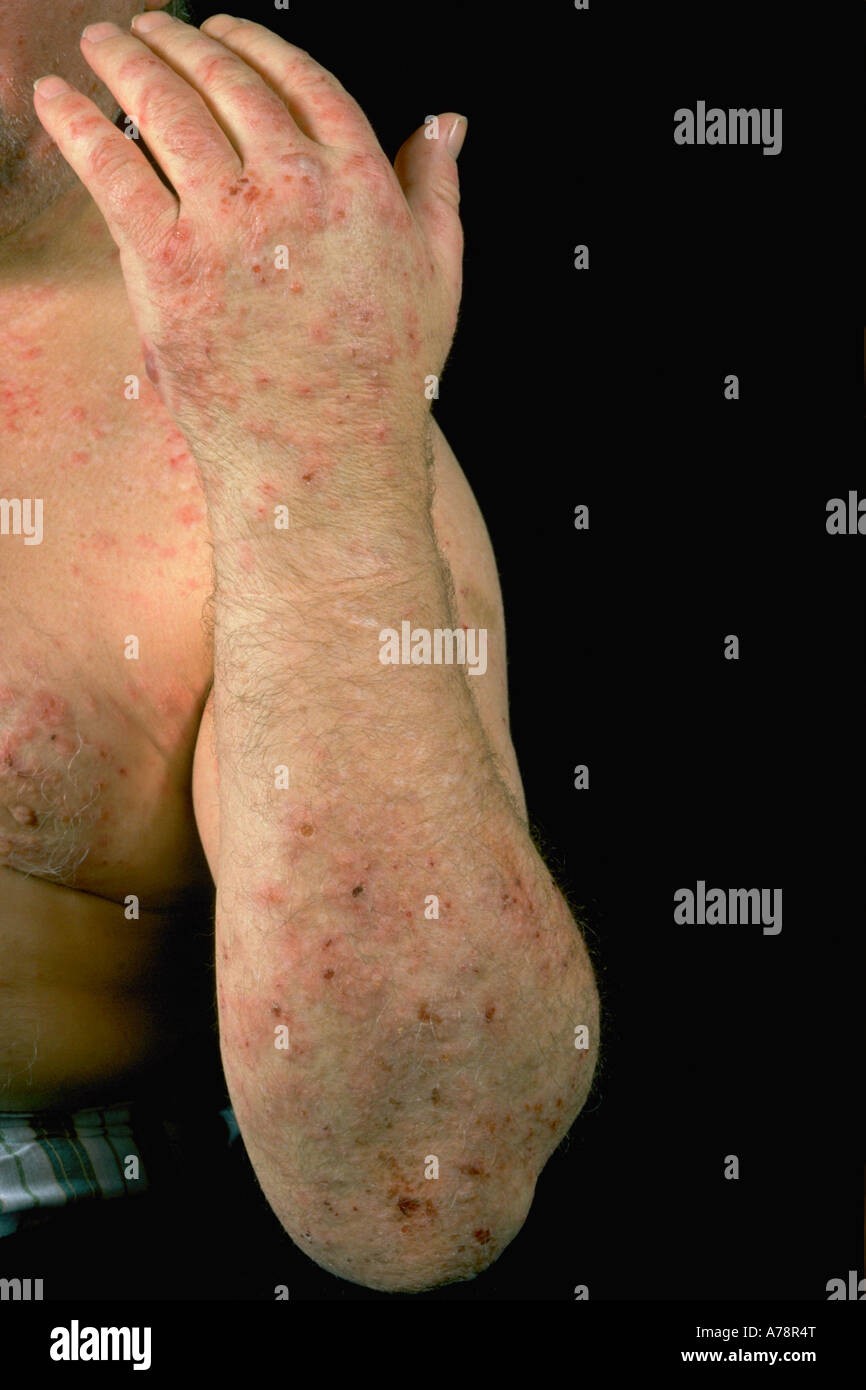 Dermatite erpetiforme Foto Stock