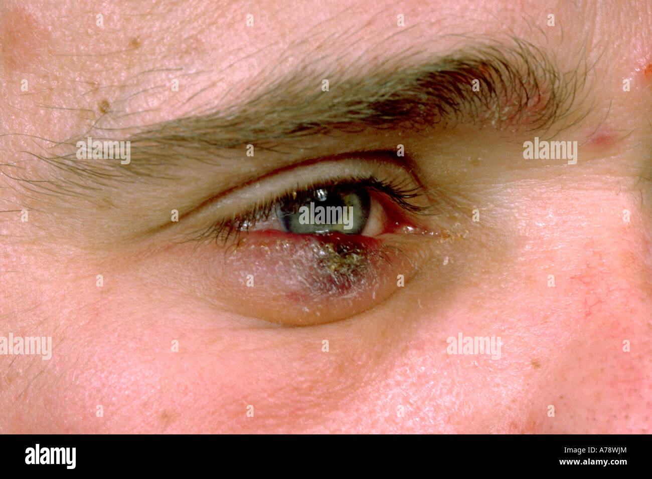 SARCOMA DI KAPOSI Foto Stock