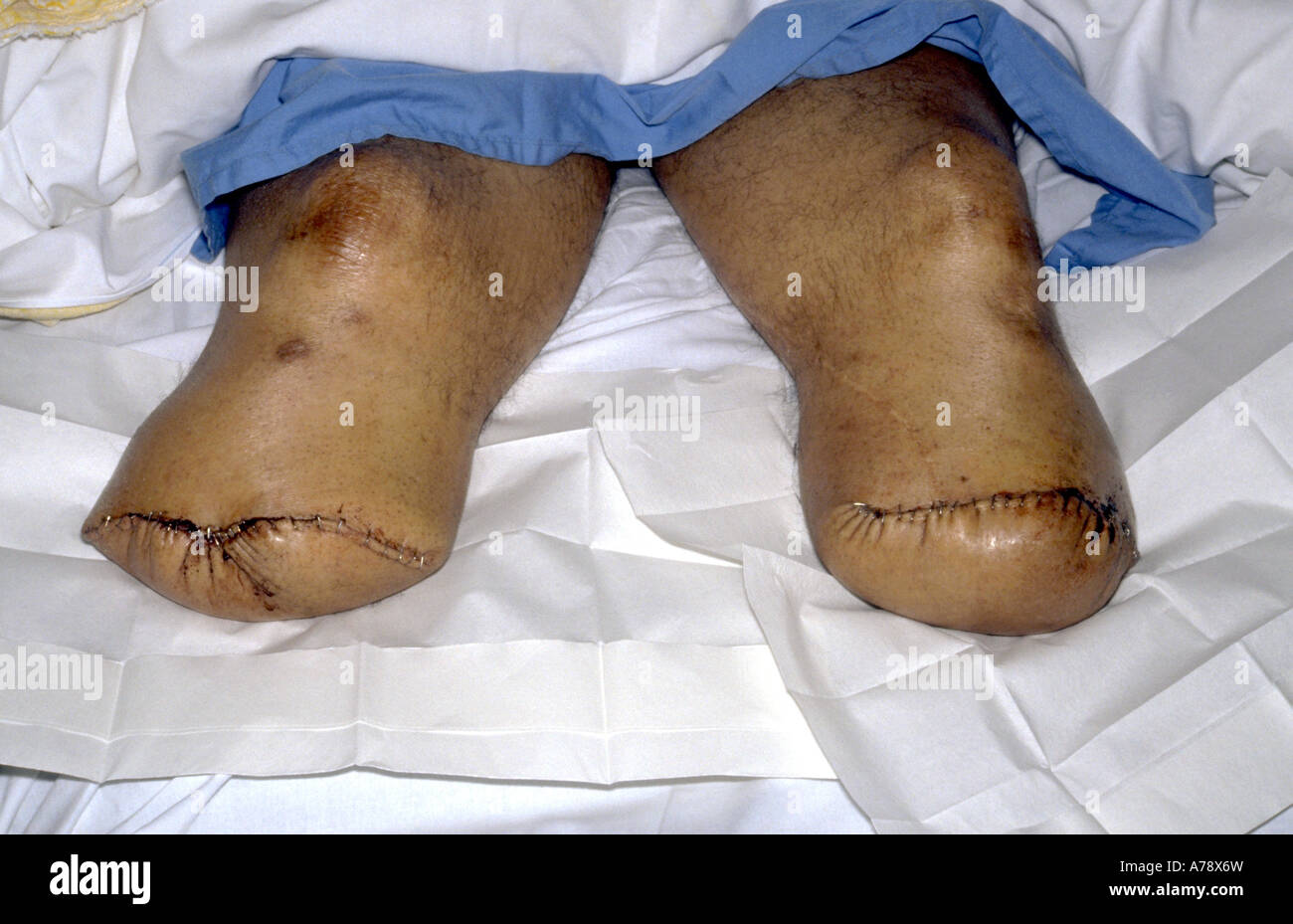 Una fotografia di un paziente con un accordo bilaterale al di sotto del ginocchio amputazione, come una conseguenza del fatto che la malattia vascolare periferica. Foto Stock