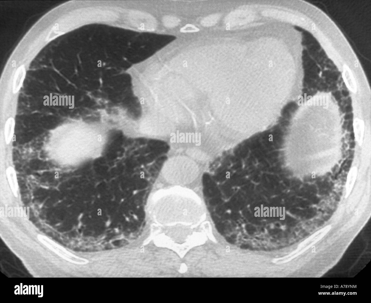 Amiodarone è un farmaco utilizzato per correggere alterazioni del ritmo cardiaco cioè un farmaci antiaritmici, che ha numerosi effetti collaterali Foto Stock