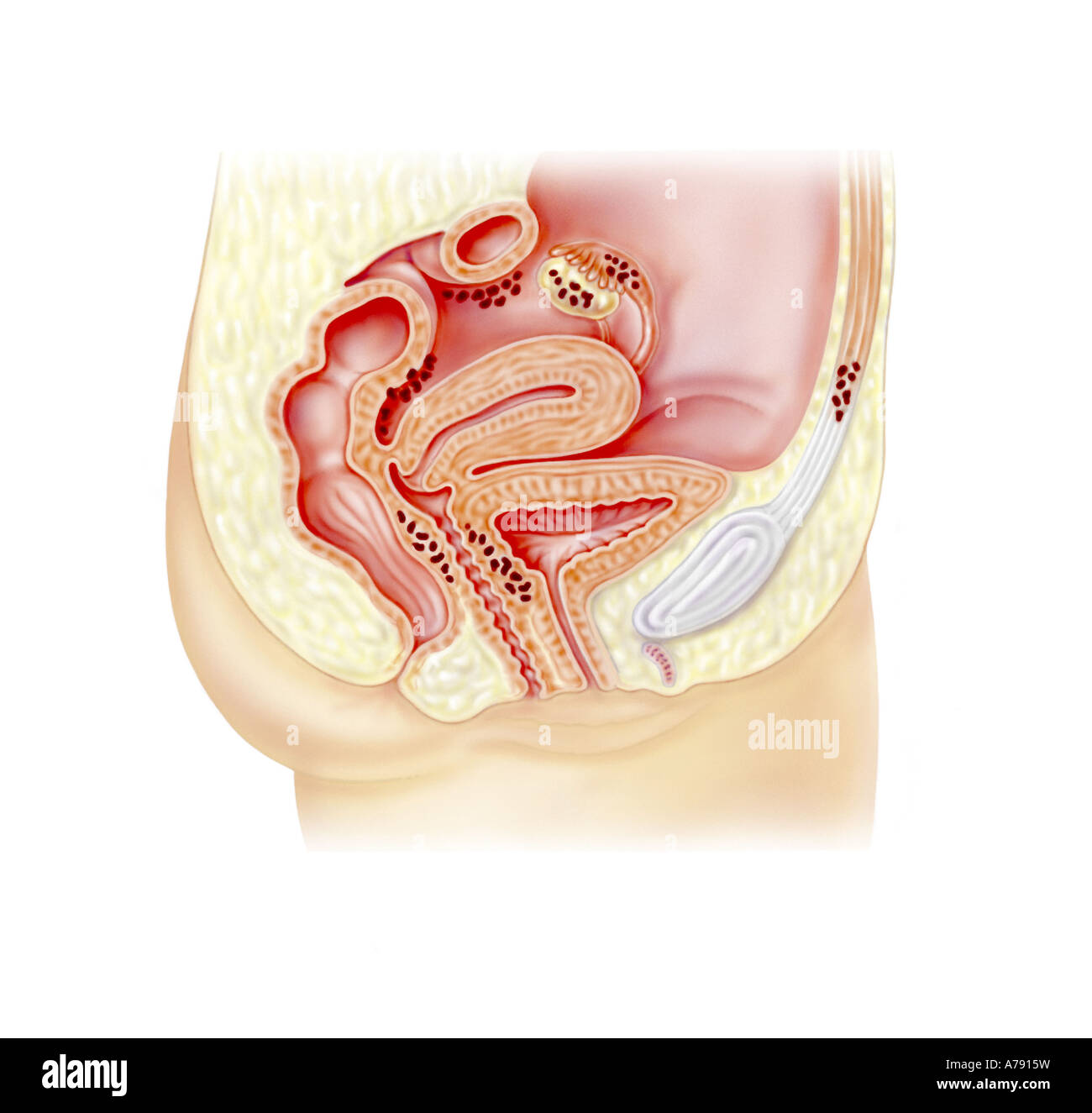 Una illustrazione di endometriosi Foto Stock