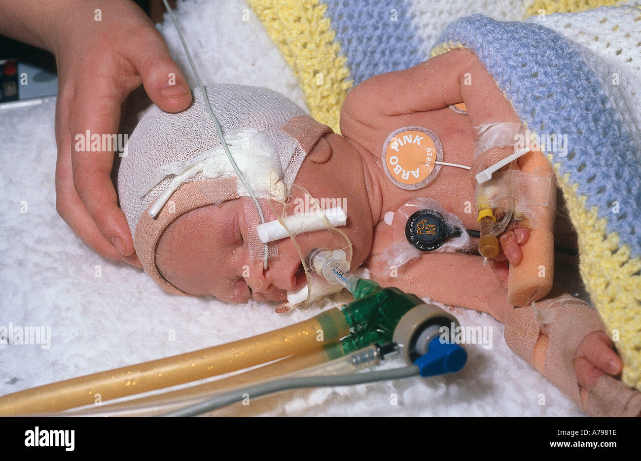 Bambino prematuro in cura speciale Foto Stock