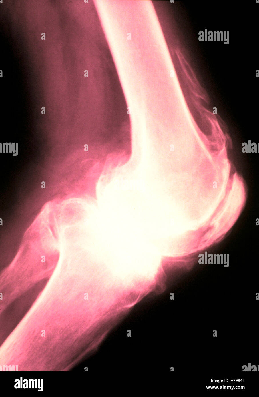 Colorati a raggi x che mostra il ginocchio artritiche Foto Stock