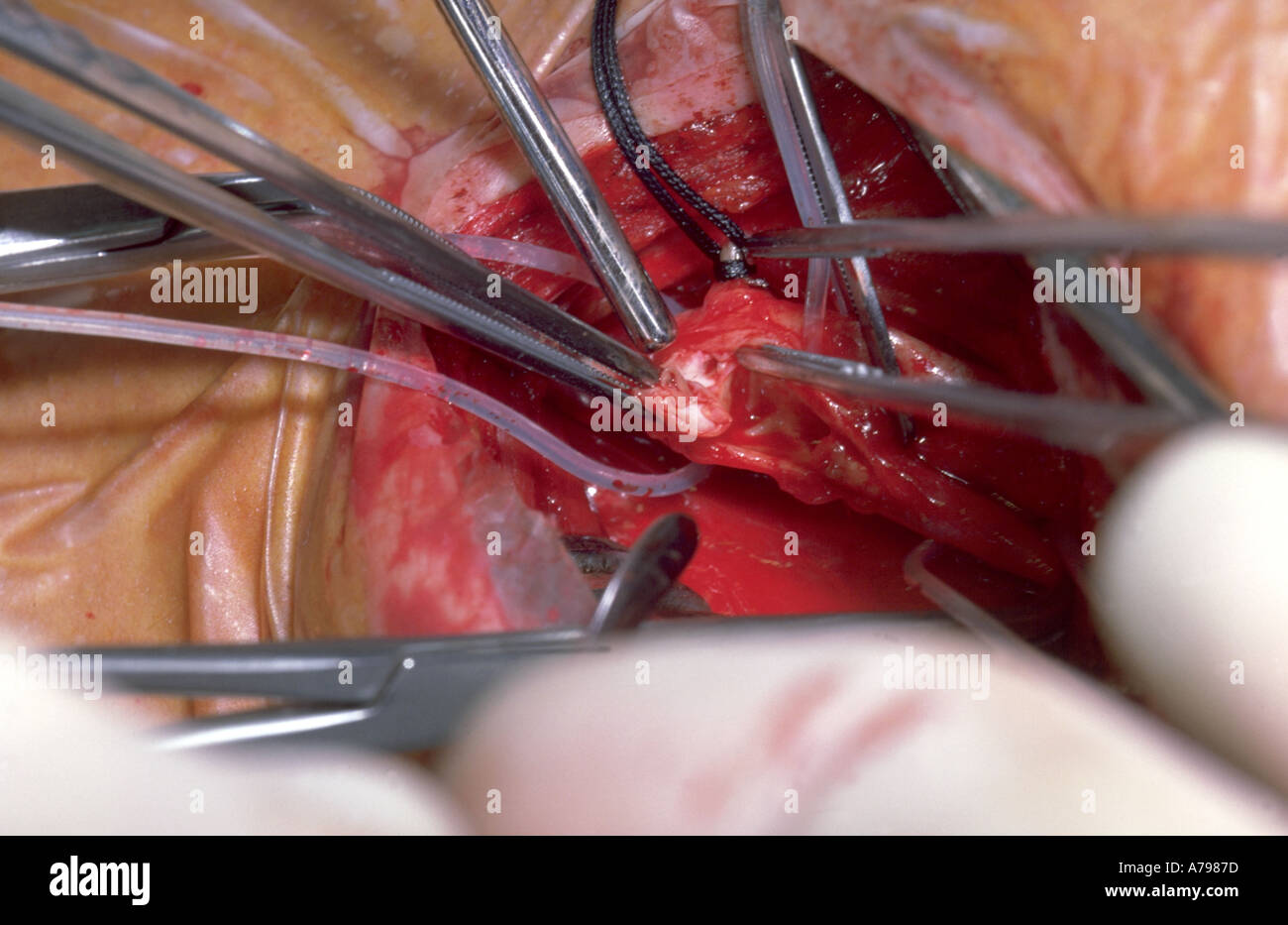 Endarterectomy carotide procedura operativa Foto Stock