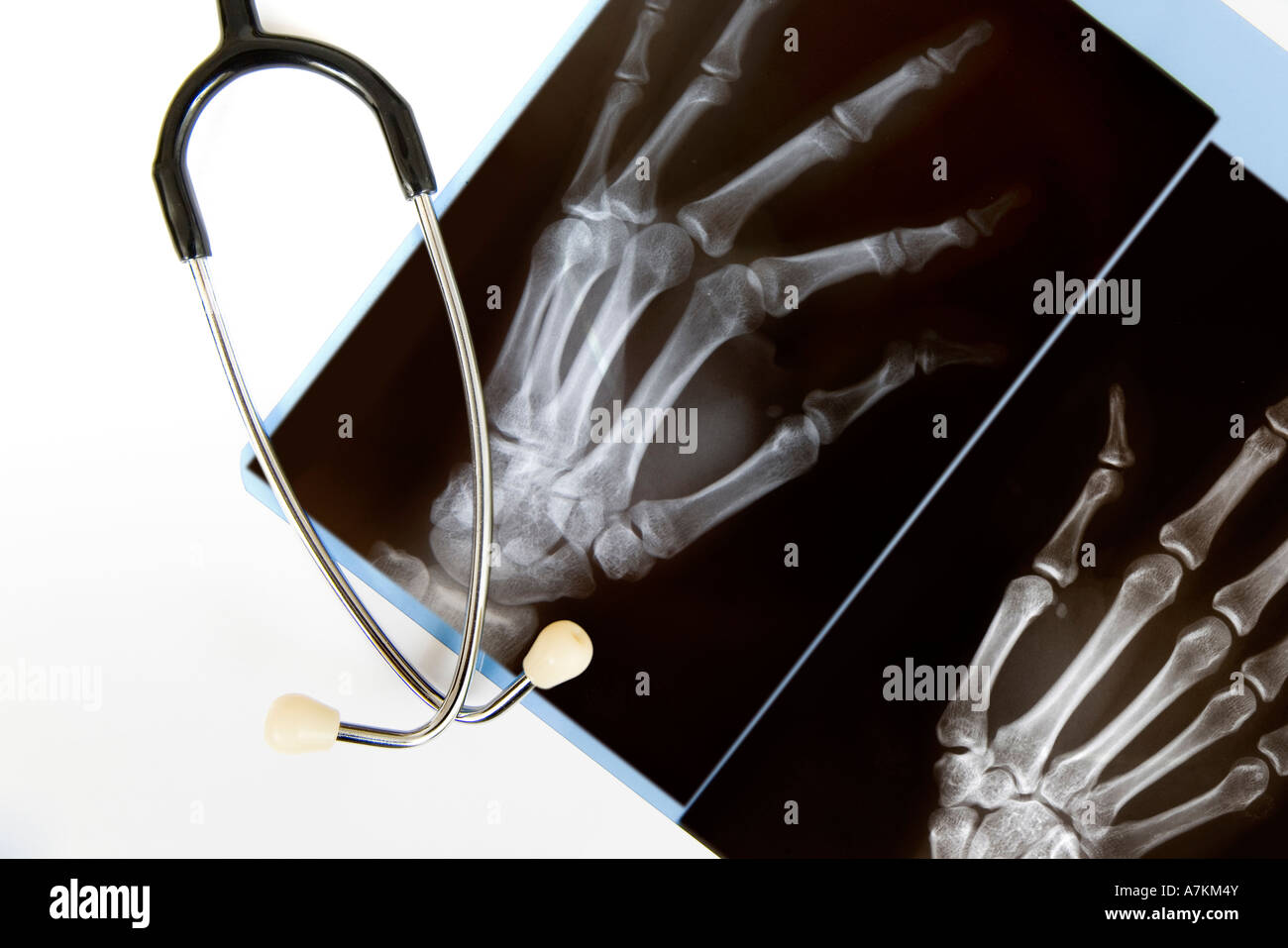 A raggi x di una mano con uno stetoscopio isolato su bianco Foto Stock