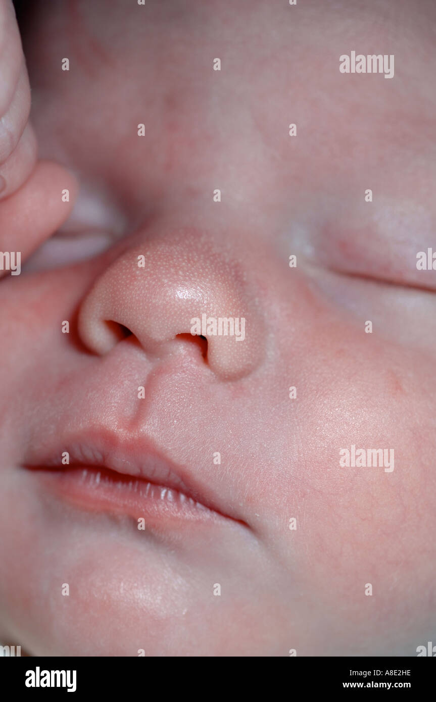 Macchie di latte o milia sul bambino del naso Foto Stock