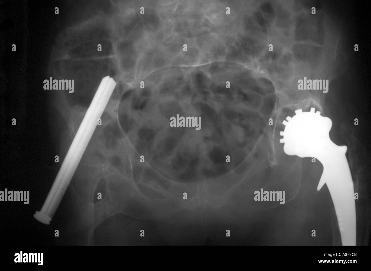 Artrodesi con smith peterson artroplastica delle unghie Foto Stock