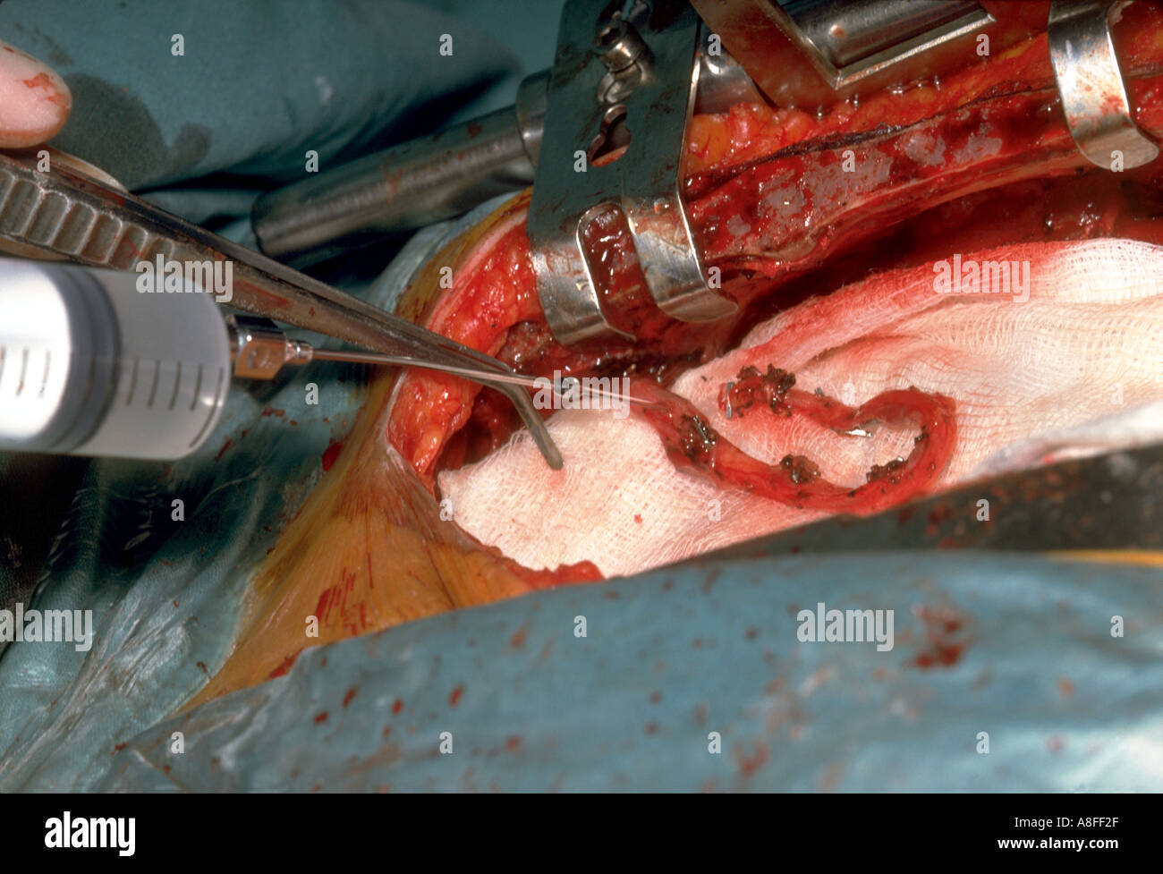 Bypass coronarico procedura Foto Stock