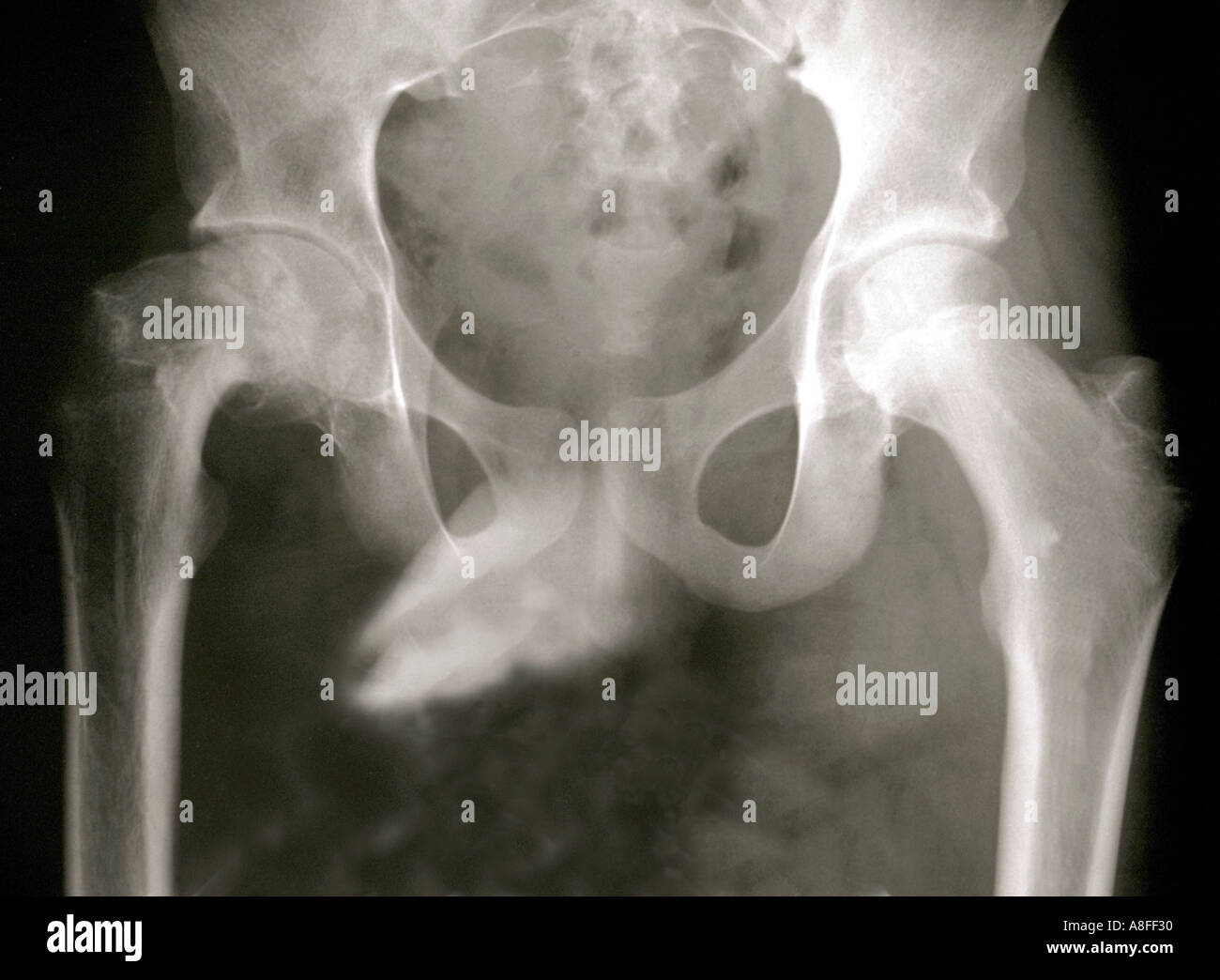 X ray scivolato superiore epifisi femorale Foto Stock
