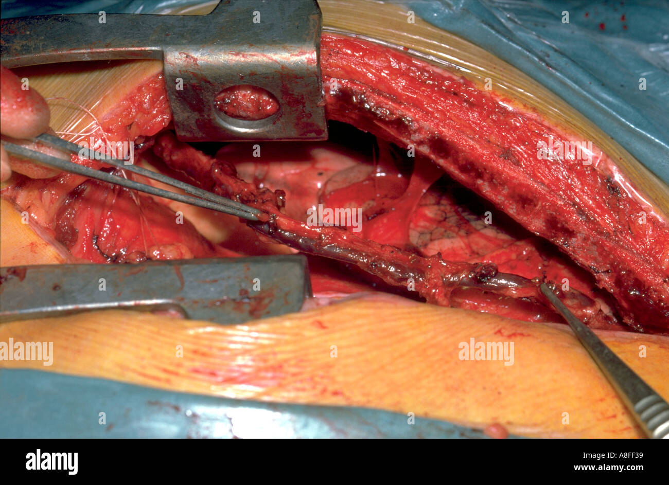 Bypass coronarico sternotomia procedura Foto Stock