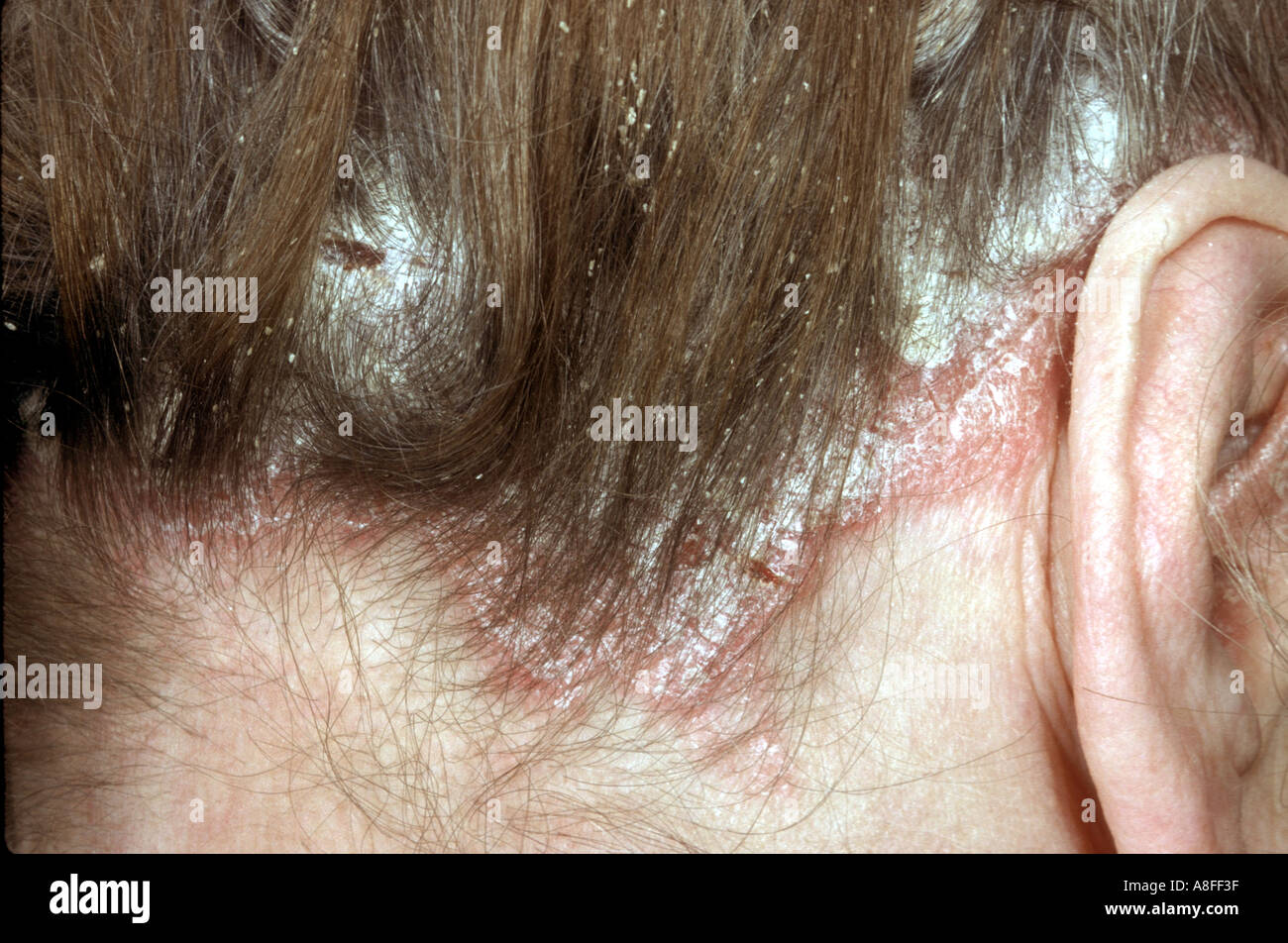 La psoriasi del cuoio capelluto Foto Stock