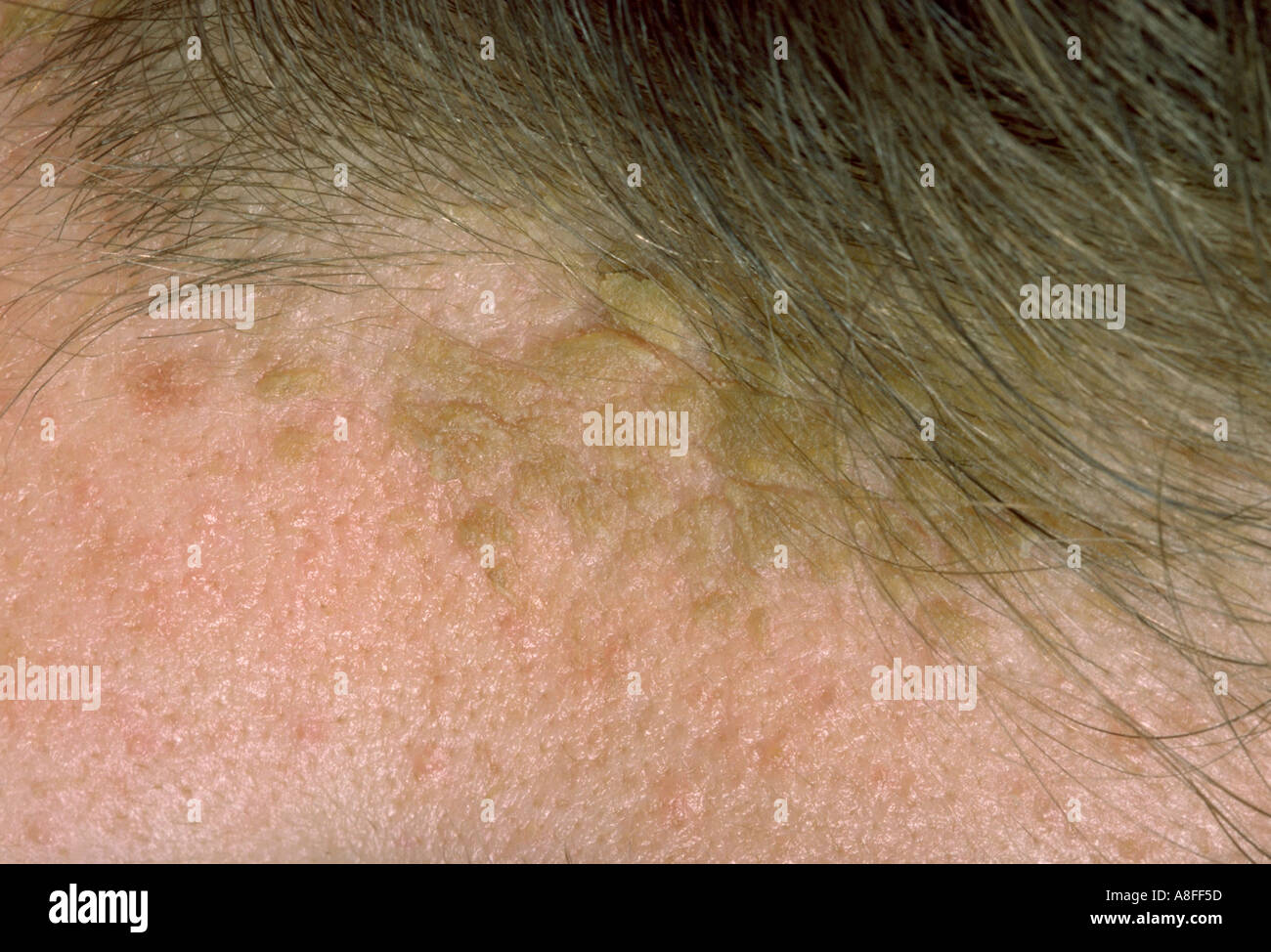 La dermatite seborroica Foto Stock