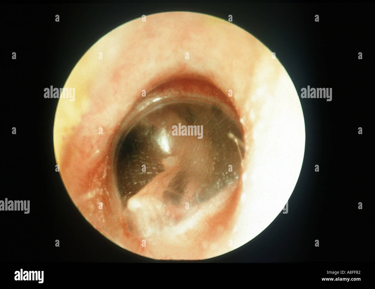 Otite media Foto Stock