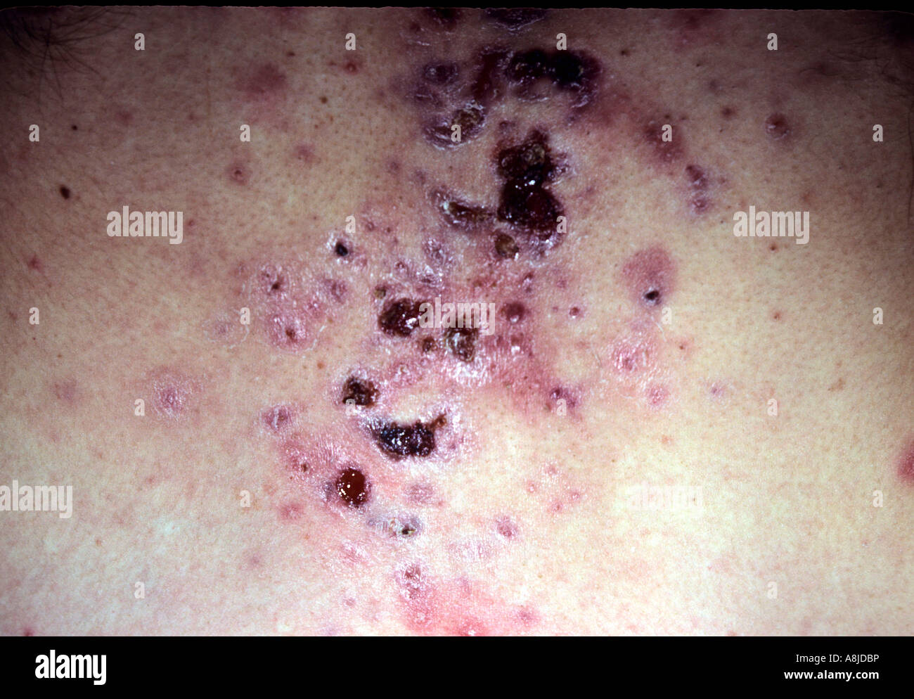 Acne vulgaris dermatologia punti neri sul petto maschio Foto Stock