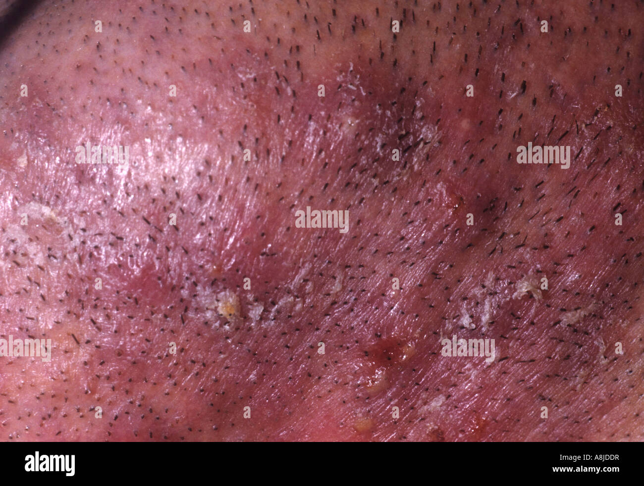 Acne vulgaris, come si è visto su pazienti viso mento. Foto Stock