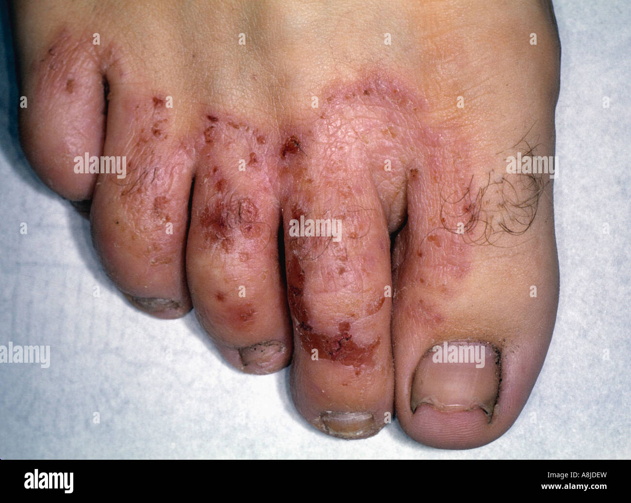 Il piede d'Atleta infezione in piedi del paziente Foto stock - Alamy
