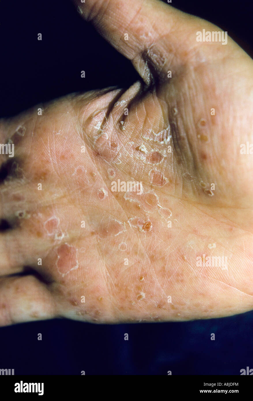 Palmaris Pustolosis è una psoriasi rash trovata nel palmo di una mano. Foto Stock
