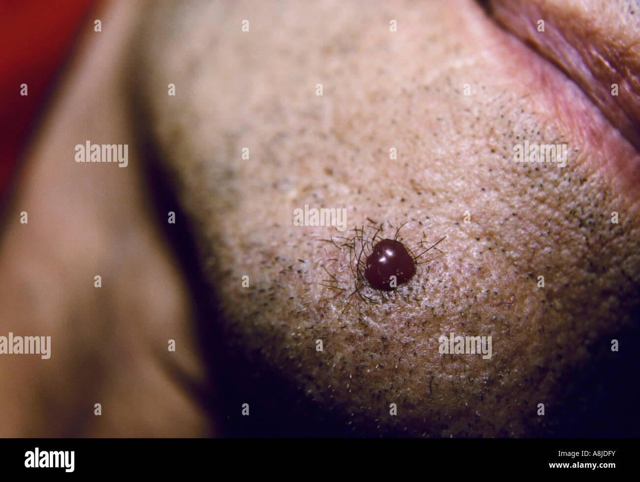 Granuloma pyogenicum, un sanguinamento reocurring lesione. Noto anche come lobulare emangioma capillare. Foto Stock