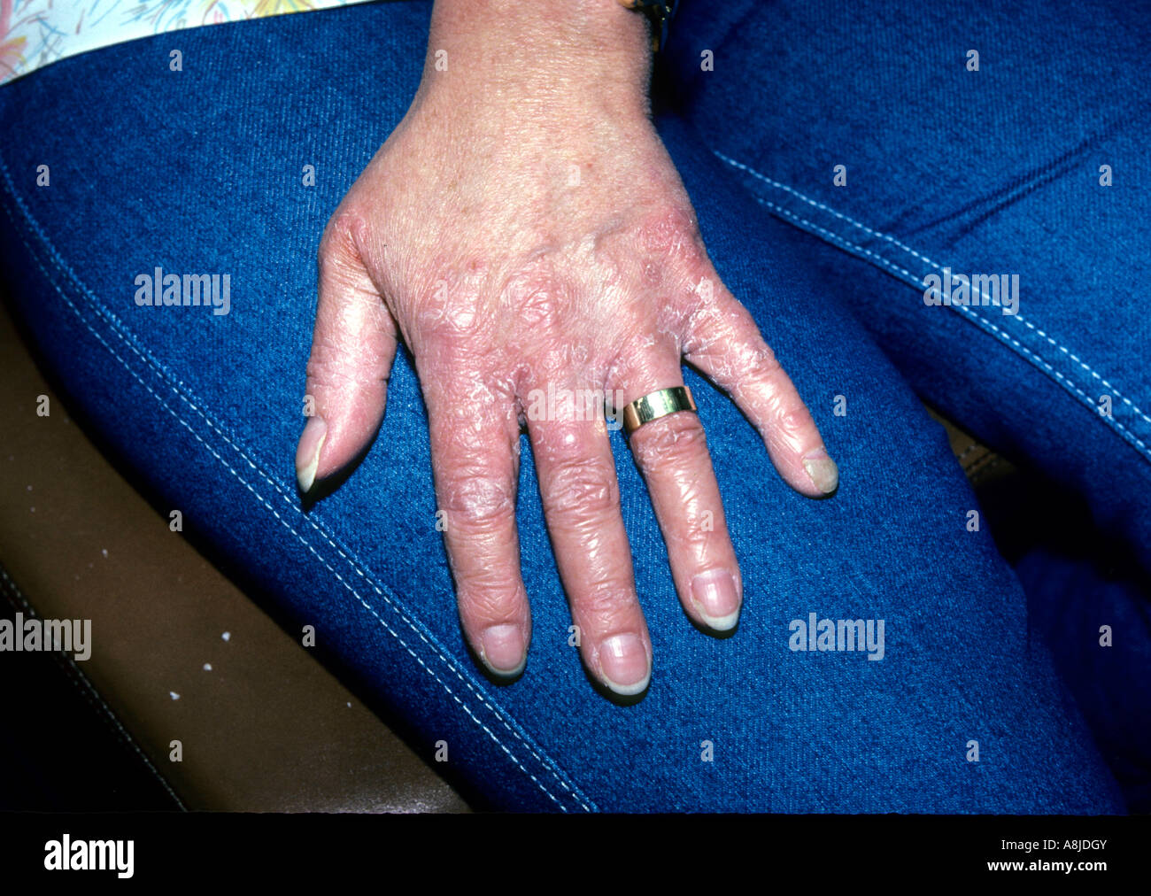 Tigna delle mani (tinea manus) particolarmente le palme e gli spazi tra le dita. Foto Stock