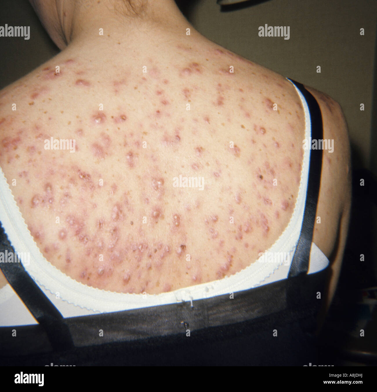 Cystica acne sulla schiena del paziente. Foto Stock