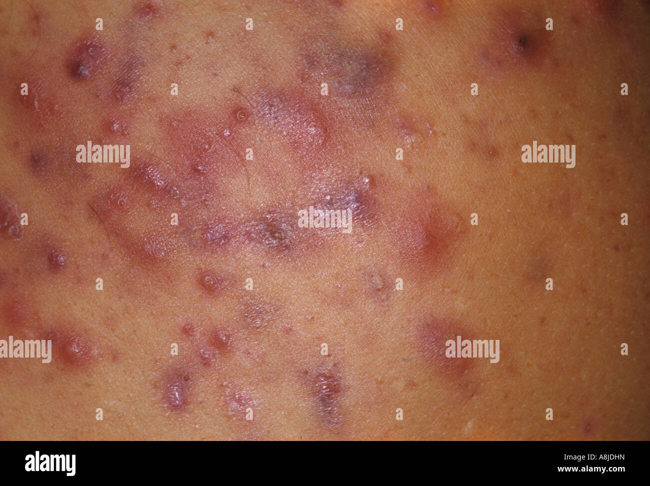 Cystica acne sul torace del paziente. Foto Stock