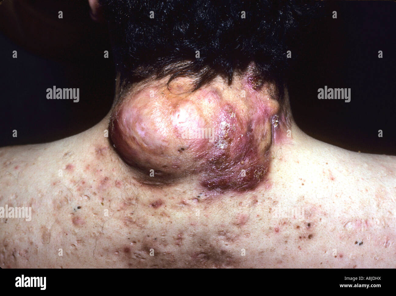 Acne vulgaris sulla schiena del paziente. Seborrea oleosa gravi. Foto Stock
