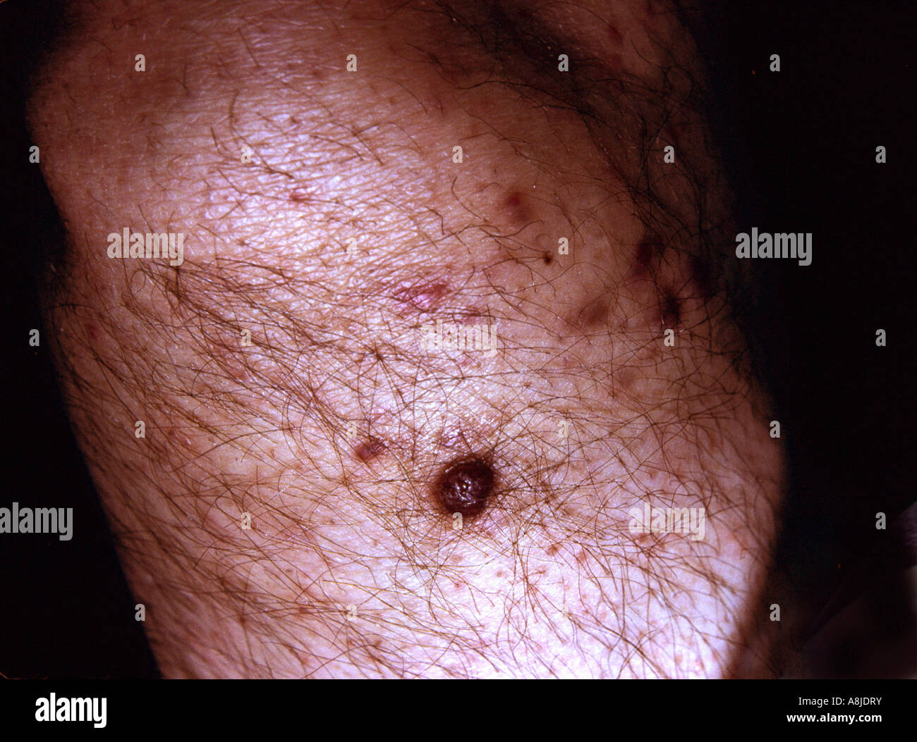 Il sarcoma di Kaposi lesioni sulla gamba del paziente. Foto Stock