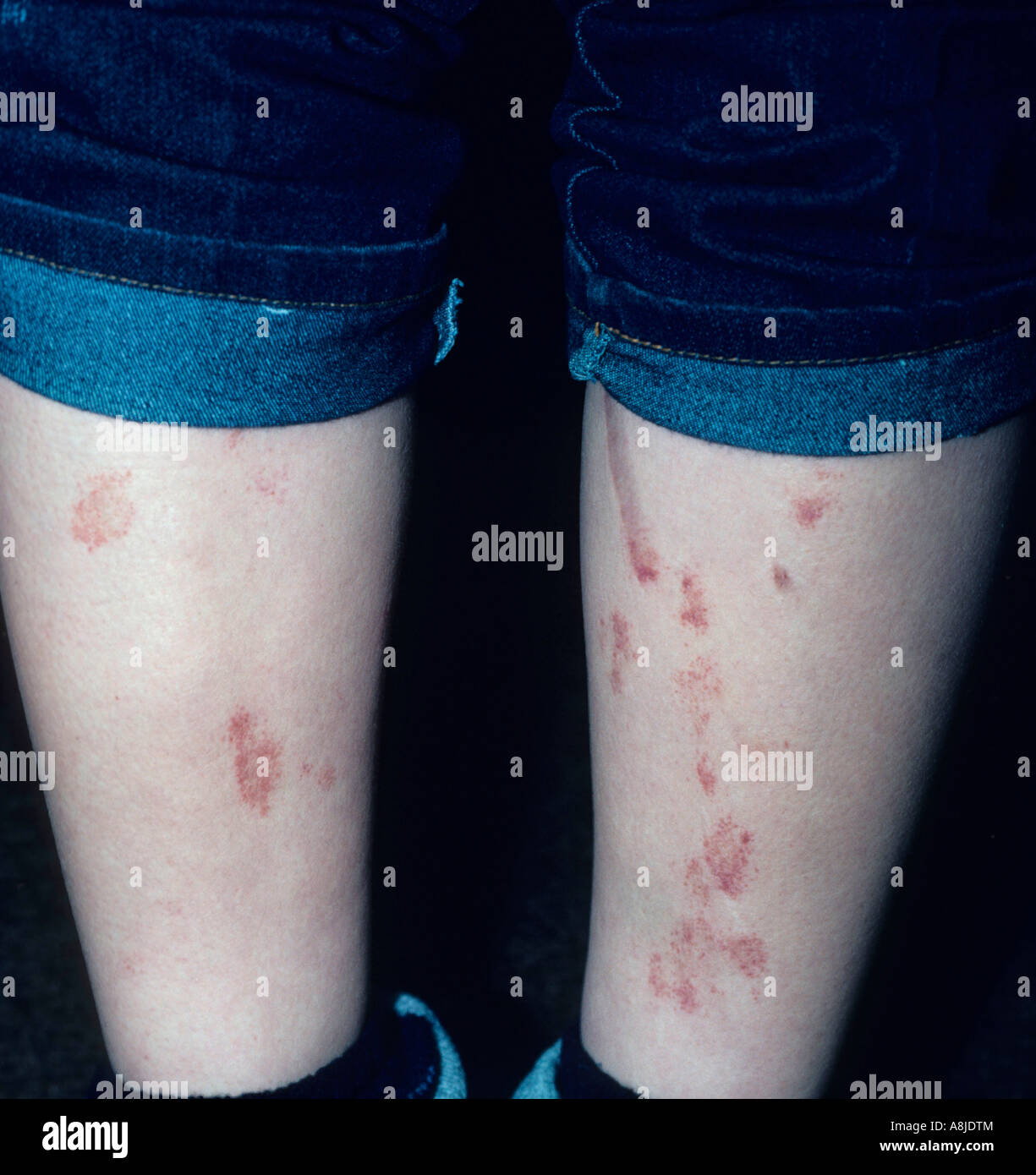 La dermatite atopica, a cui viene comunemente fatto riferimento come eczema, è una malattia cronica della pelle spesso presentando squamosa e pruriginosa eruzioni cutanee. Foto Stock