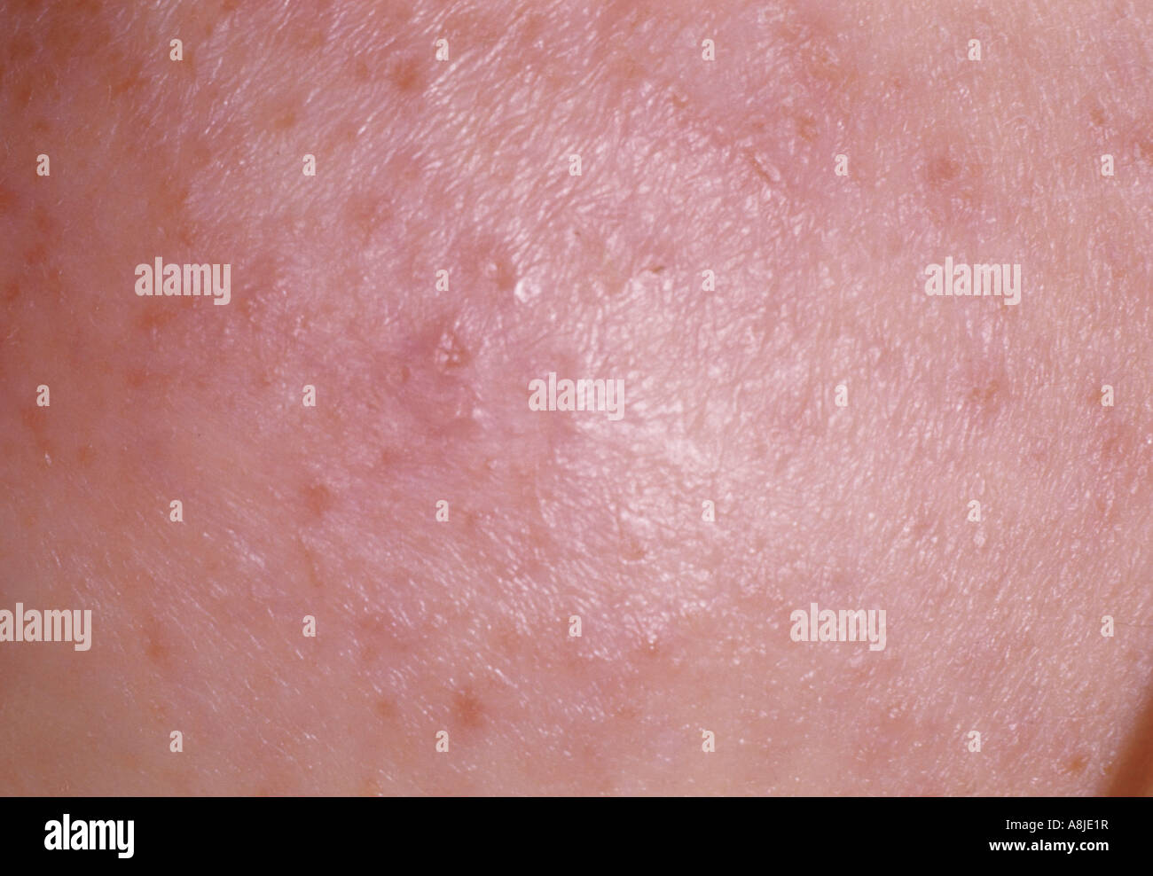 Vista ravvicinata di eczema infantile su un giovane bambino del viso. Noto anche come dermatite atopica. Foto Stock