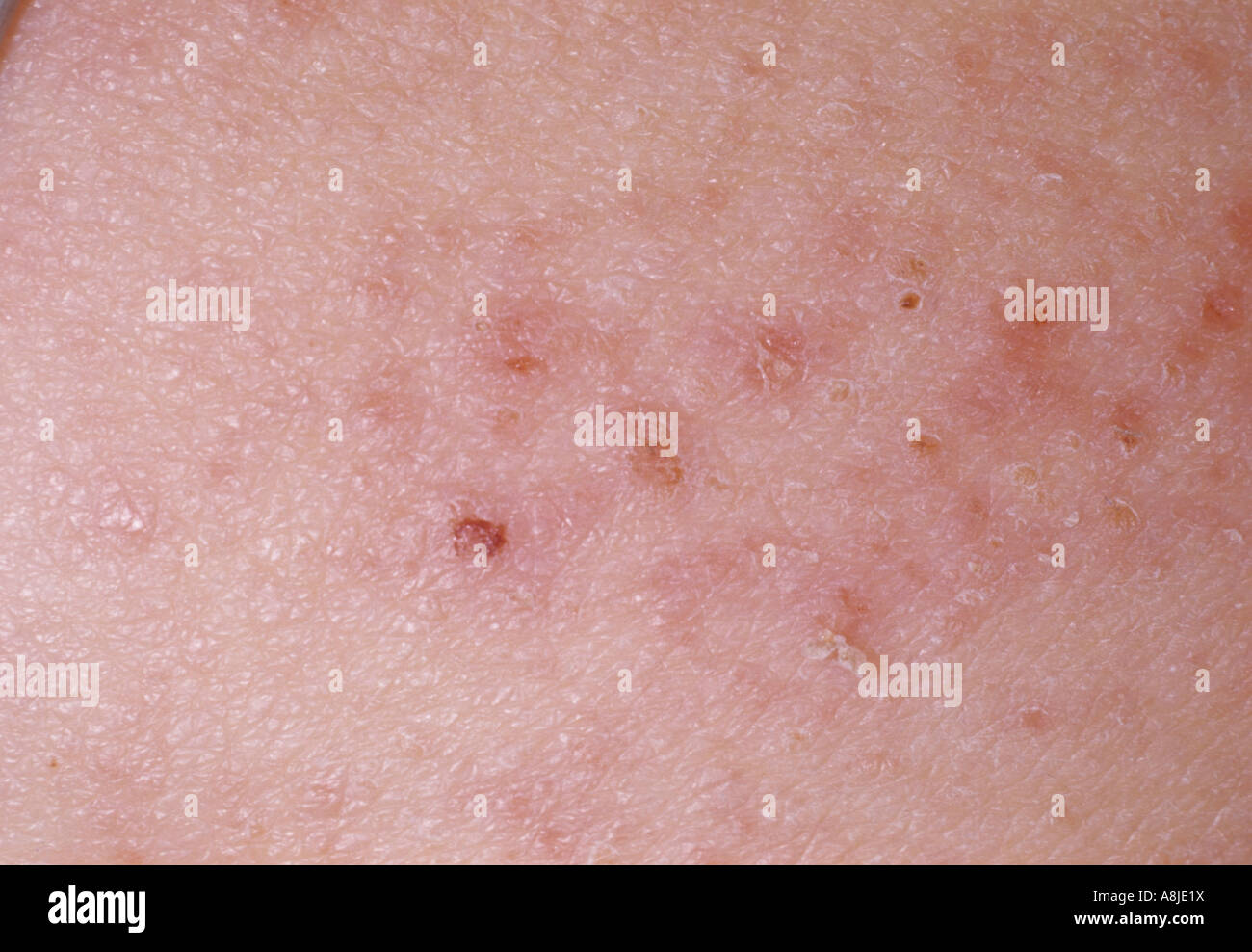 Vista ravvicinata di eczema infantile su un giovane bambino indietro. Noto anche come dermatite atopica. Foto Stock