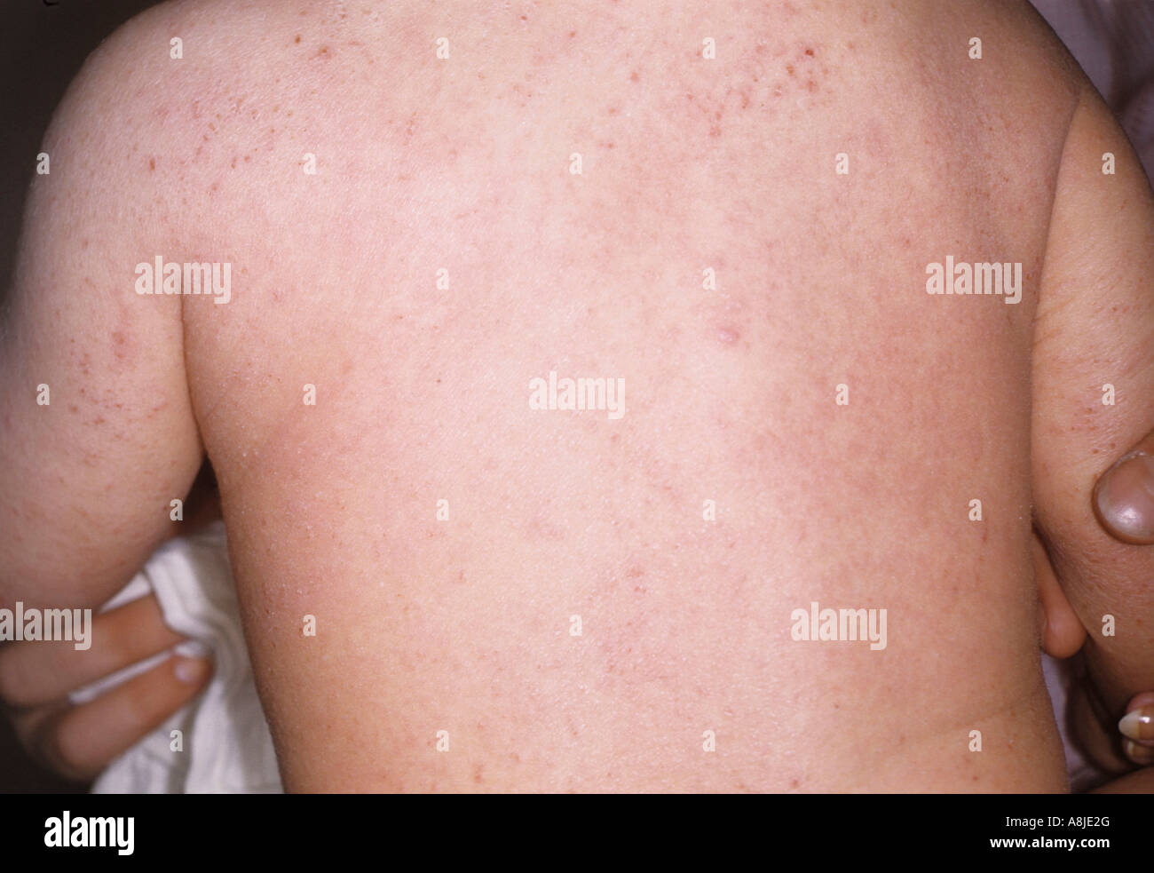 Eczema Infantile su un bambino con la schiena. Chiamato anche la dermatite da contatto. Foto Stock