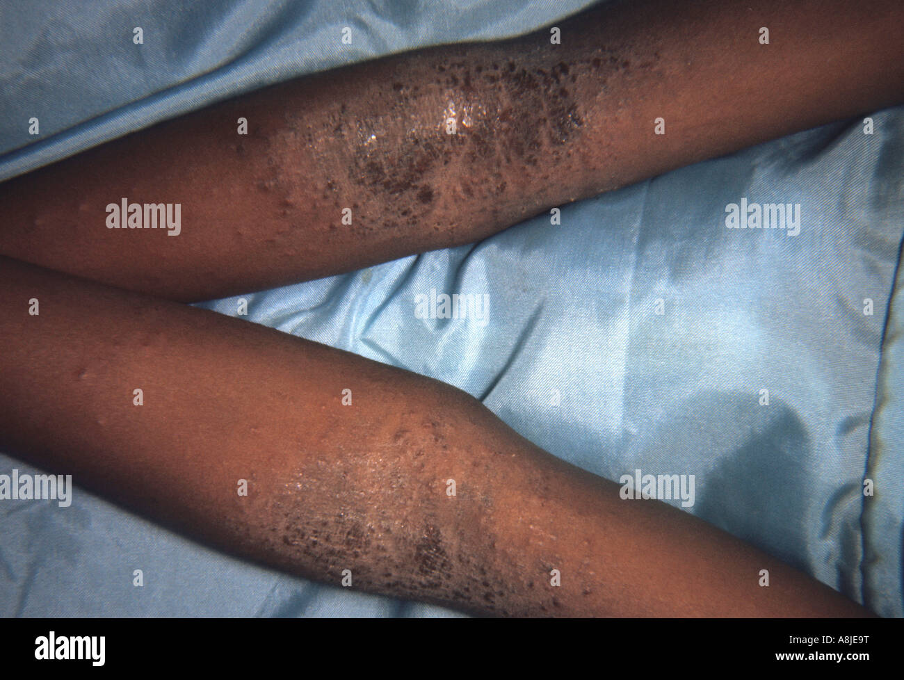 Dermatite atopica su bracci, presentando un'epidermide infiammazione. Foto Stock