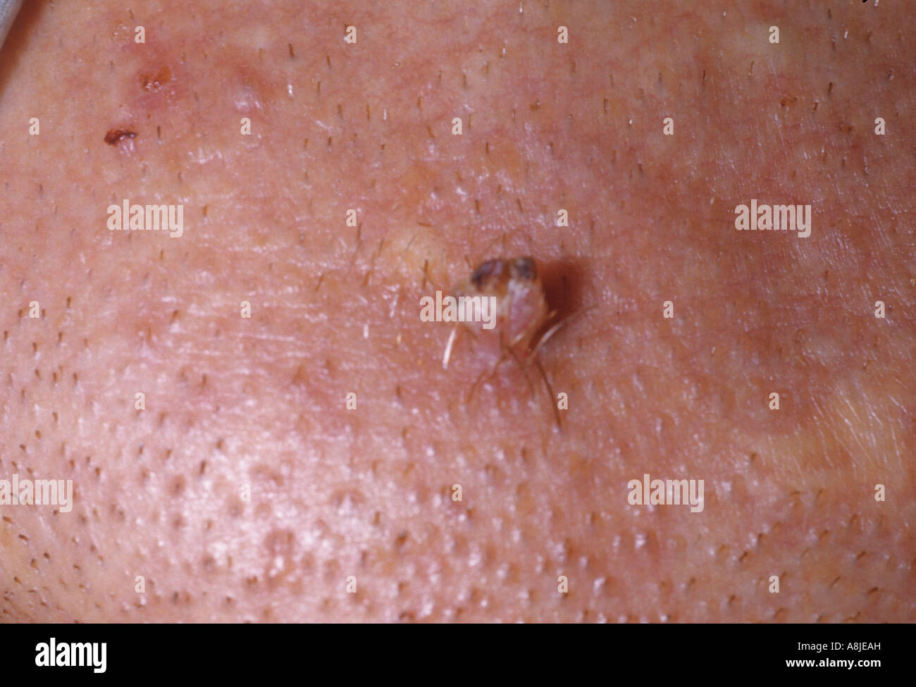 Verruca sul mento causate dall'HPV - Human Papilloma Virus Foto Stock