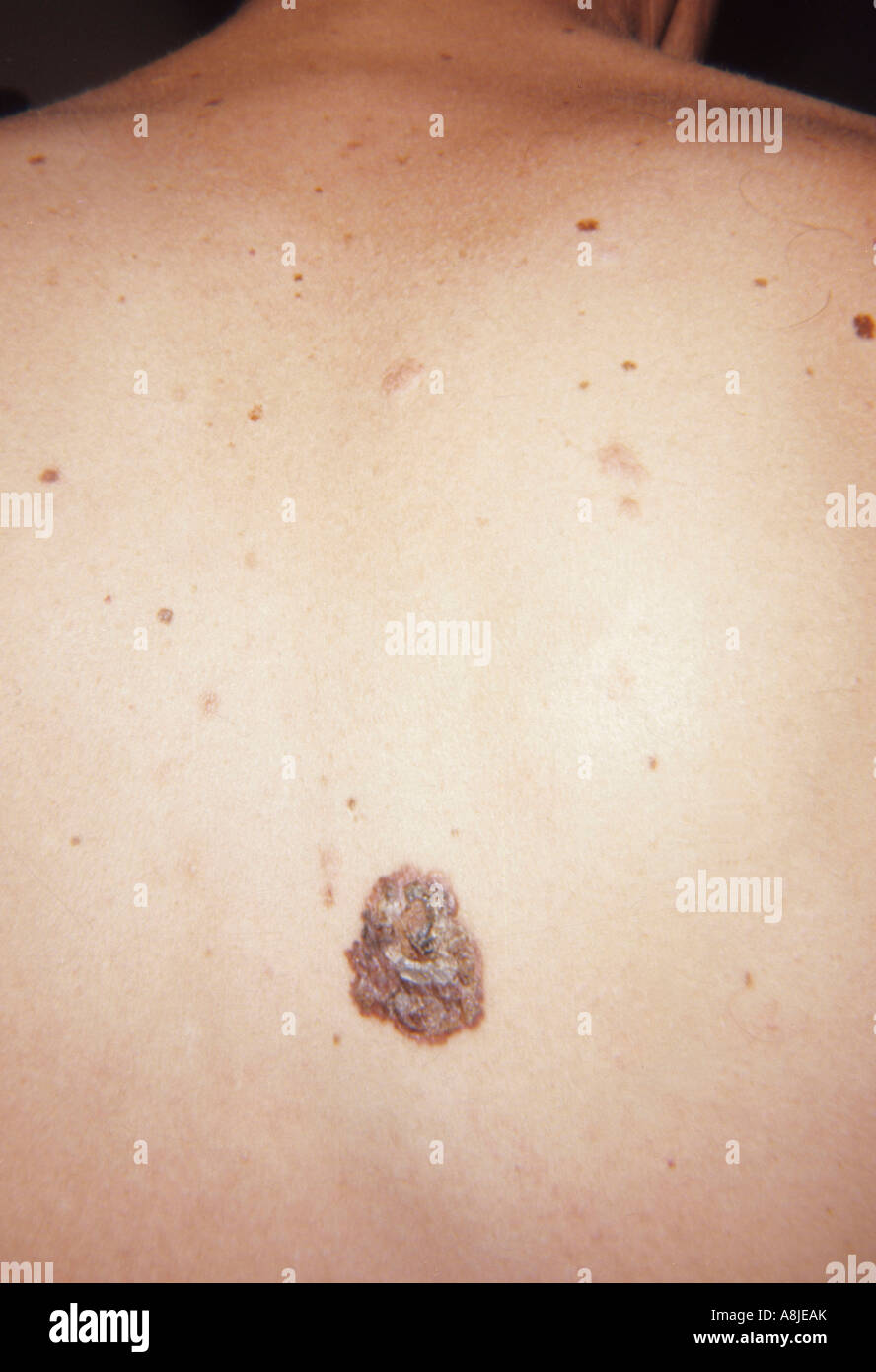 Nodulari melanoma maligno cancro sulla schiena del paziente. Foto Stock