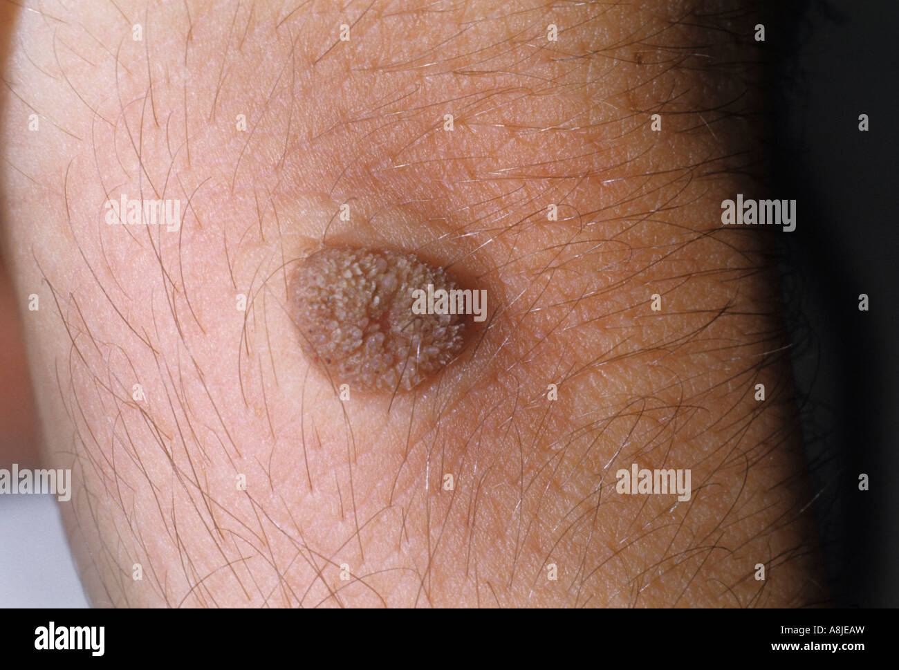 Verruca sul polso causate dall'HPV (papilloma virus umano). Foto Stock