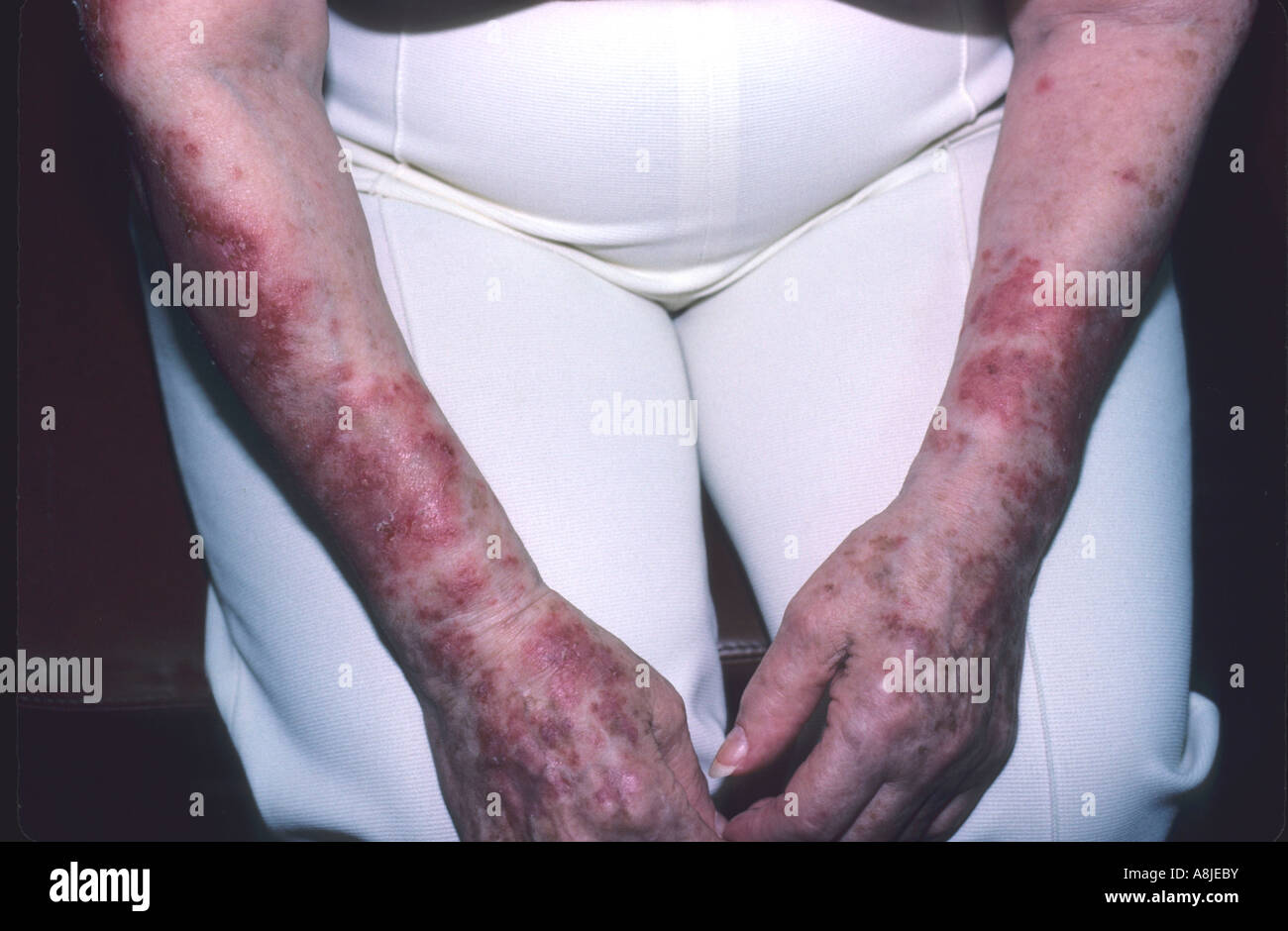 Lupus eritematoso mostrato su pazienti bracci. Foto Stock