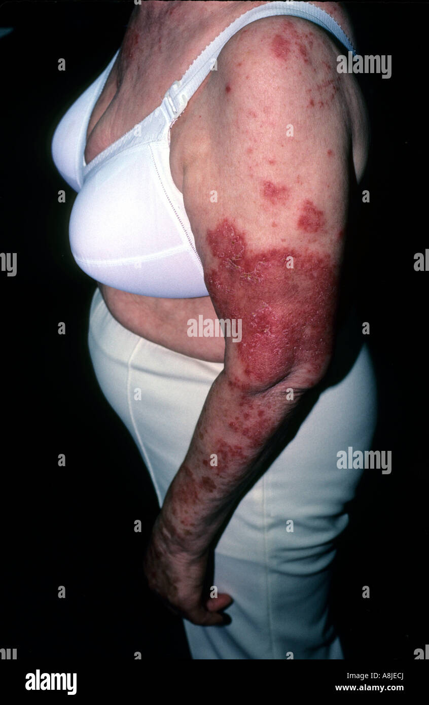 Lupus eritematoso sistemico. Il Lupus è una malattia cronica malattia autoimmune. Foto Stock
