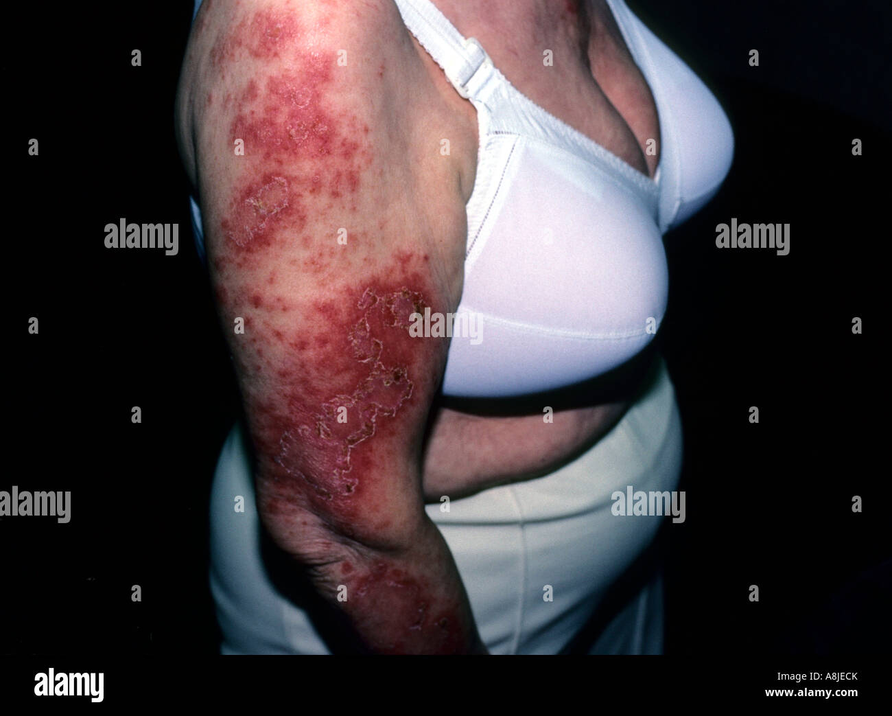 Lupus eritematoso sistemico. Il Lupus è una malattia cronica malattia autoimmune. Foto Stock