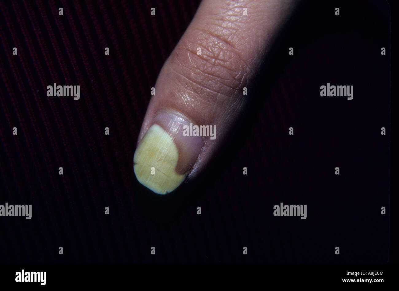 La dermatite da contatto che interessano le unghie. Eczematose sul dito. Foto Stock