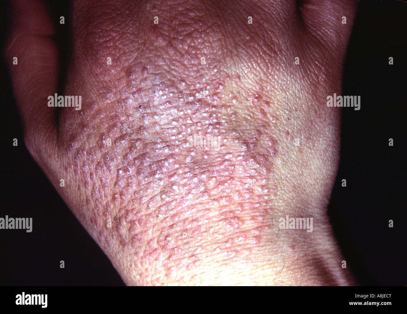 La dermatite da contatto sul lato, eczematose. Reazione potrebbe essere causata da guanti o di una sostanza chimica. Foto Stock