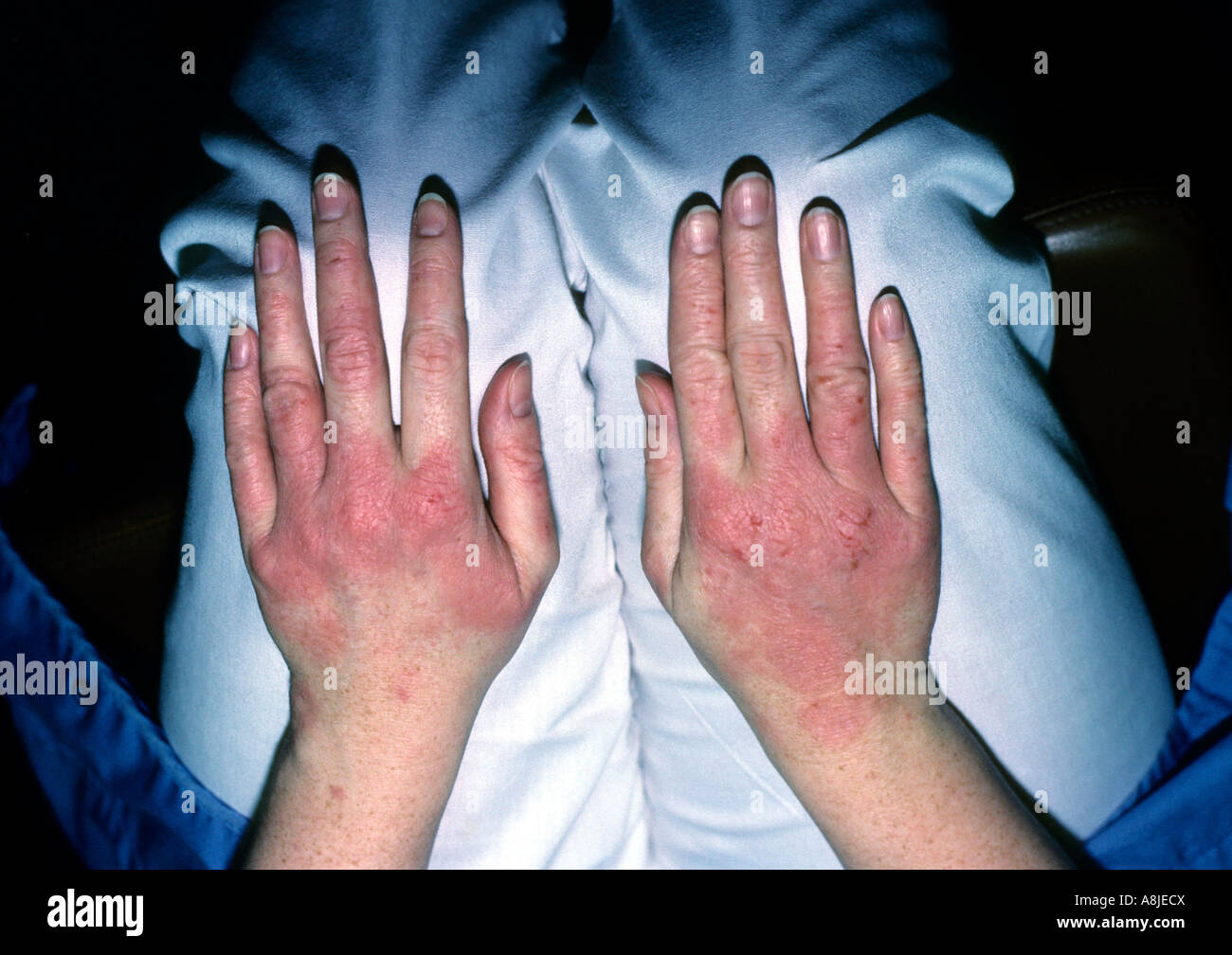 La dermatite da contatto su mani, eczematose. La causa potrebbe essere da guanti chemical Foto Stock