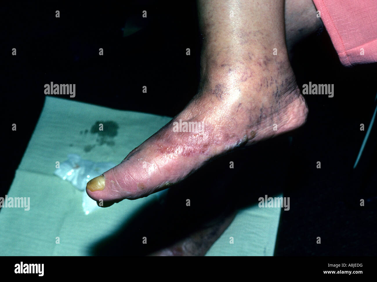 La dermatite da contatto eczematose sul piede. Foto Stock