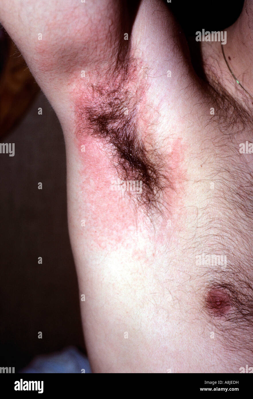 La dermatite da contatto eczematose sotto il braccio del paziente. Foto Stock