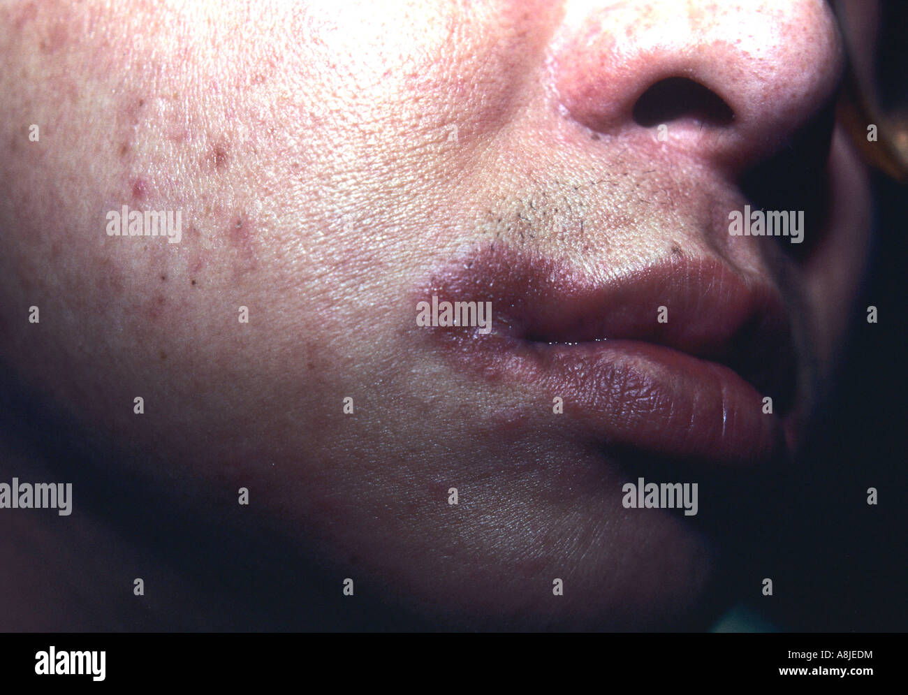 La dermatite da contatto sulle labbra. Eczematose Foto Stock
