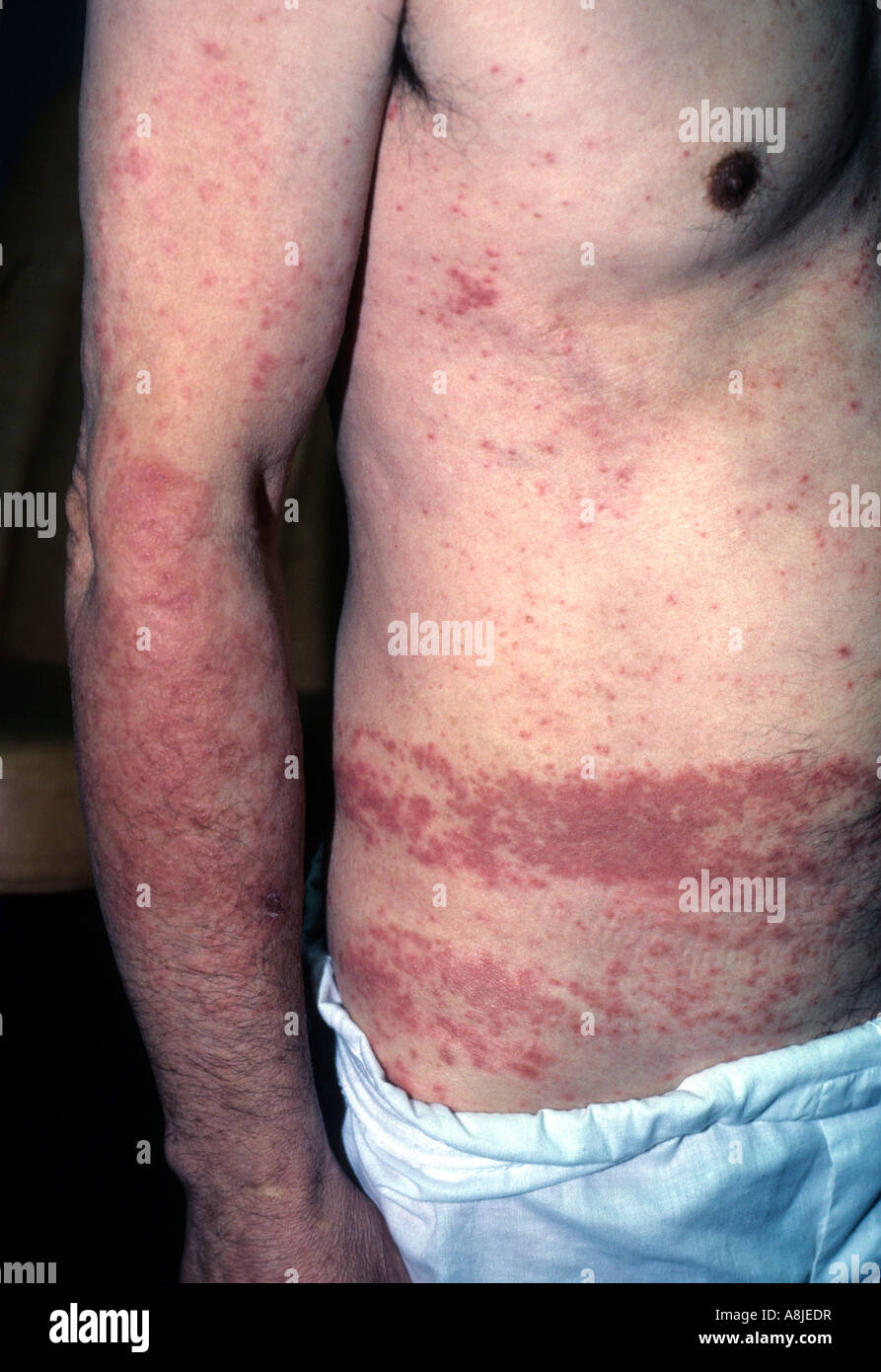 La dermatite da contatto sul corpo del paziente a causa dei suoi vestiti sono troppo strette. Foto Stock