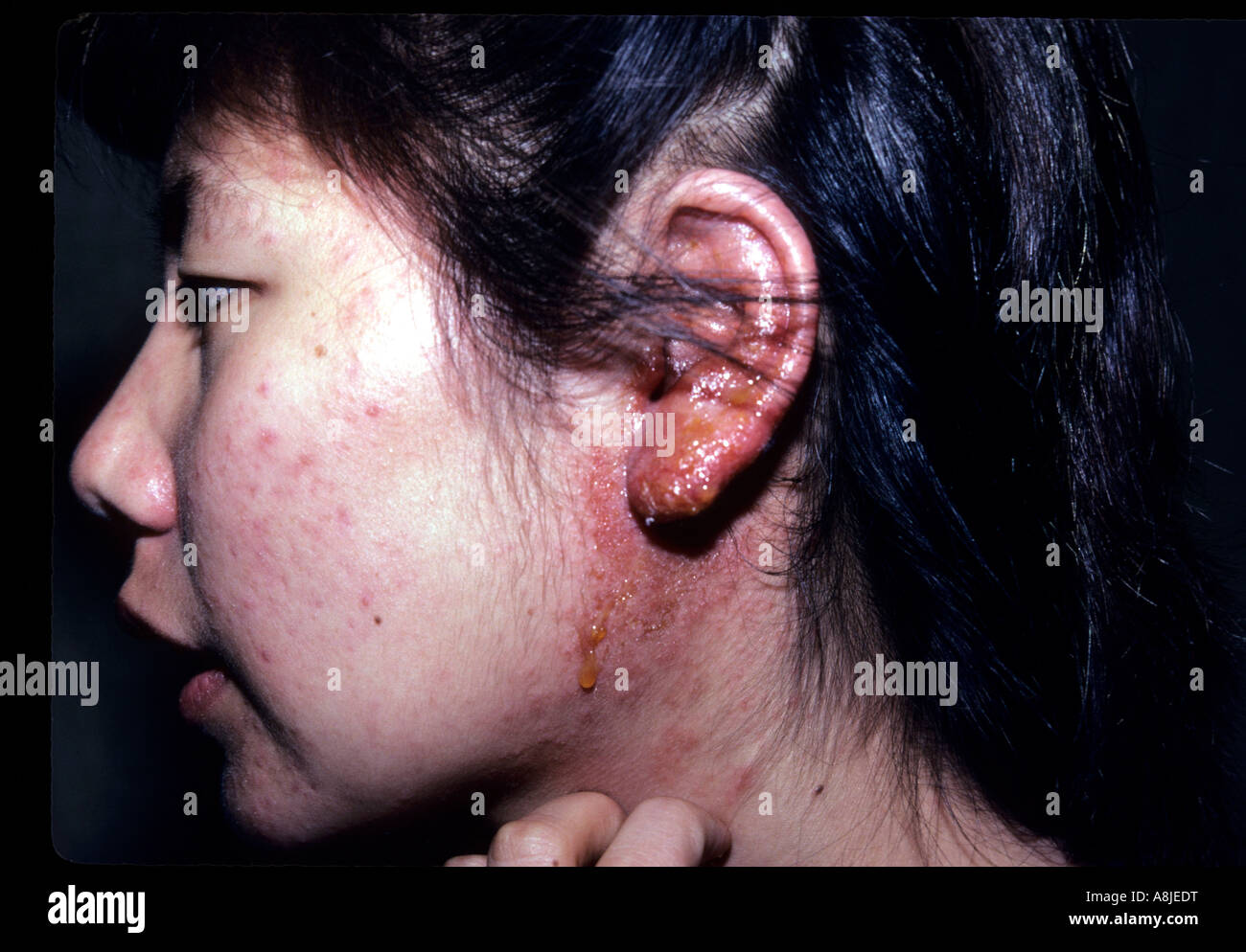 La dermatite da contatto a causa di una reazione allergica per i metalli nella sua orecchini. Foto Stock