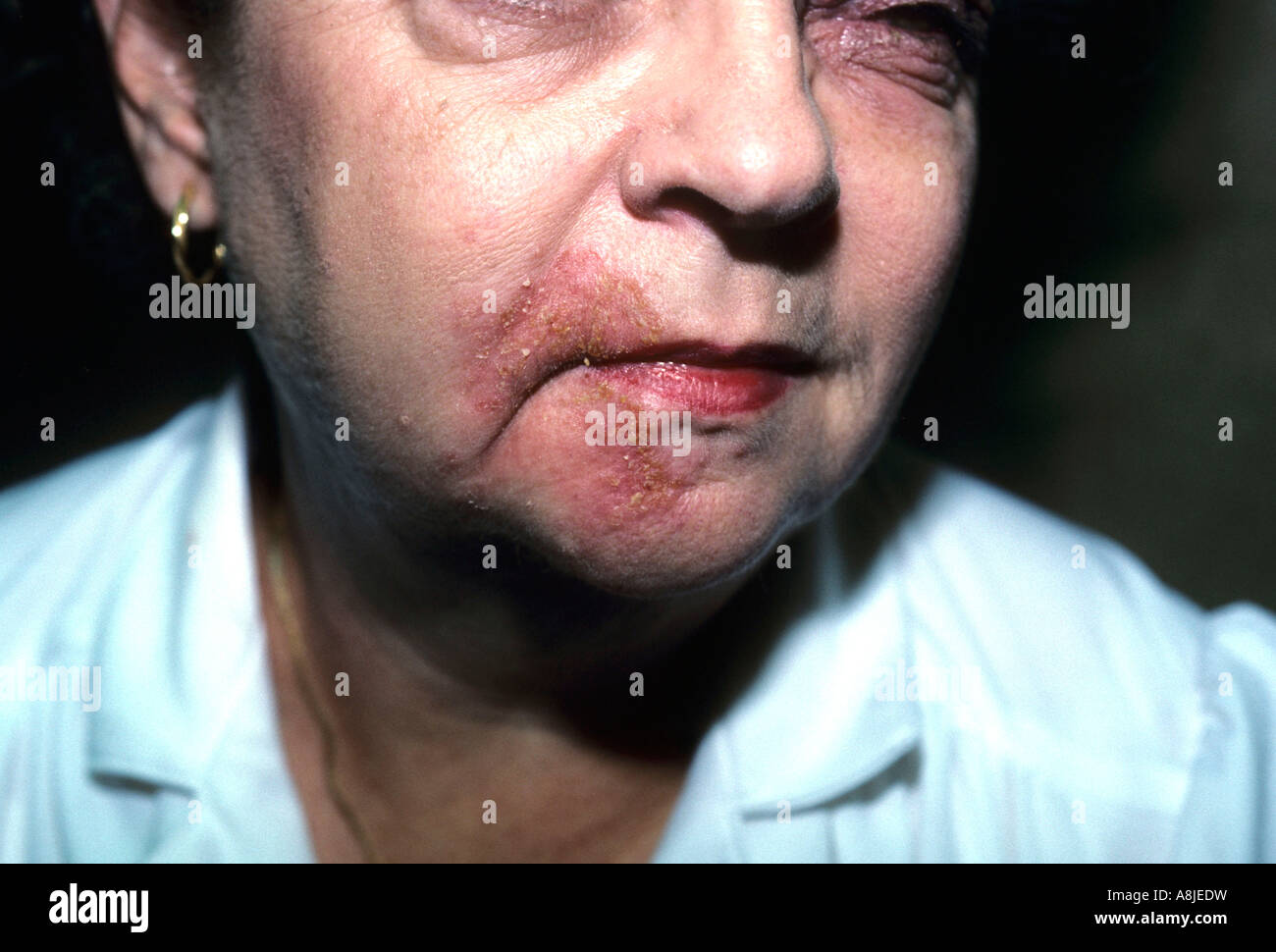 La dermatite da contatto sul viso del paziente a causa di una reazione allergica a cosmetici. Foto Stock