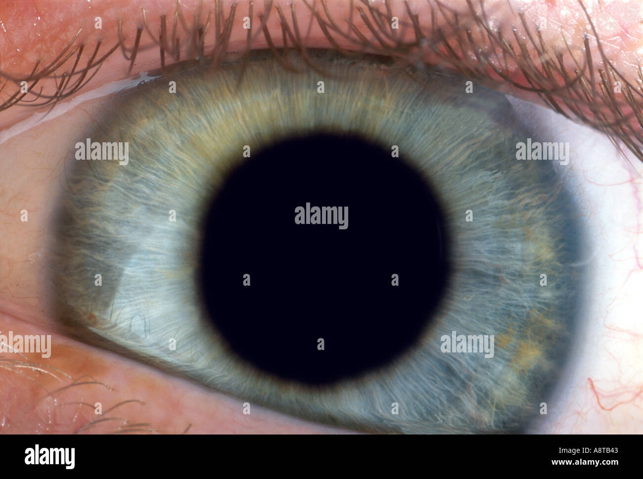 Occhio umano dilatato Foto Stock