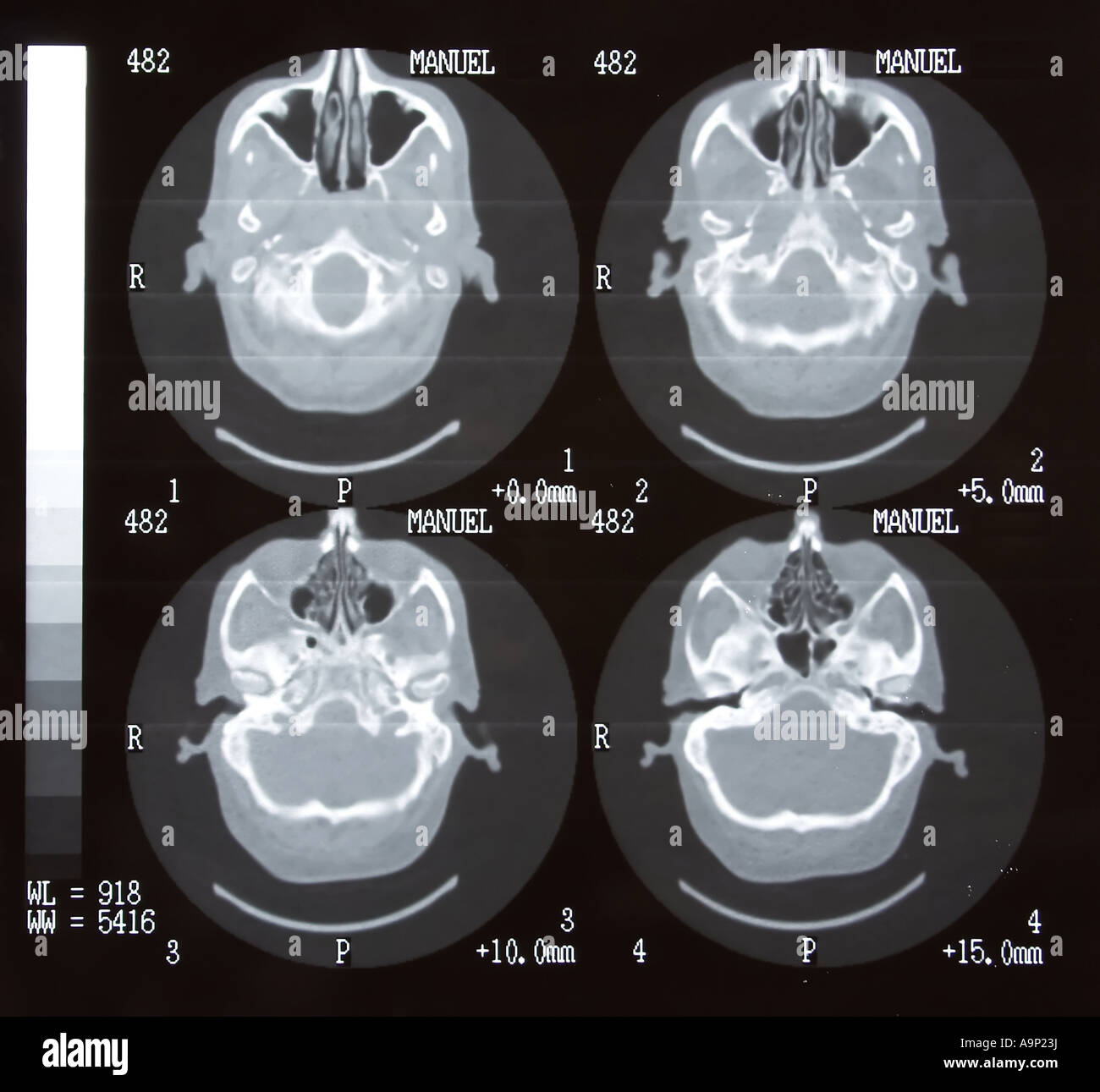 Tomografia cerebrale Foto Stock