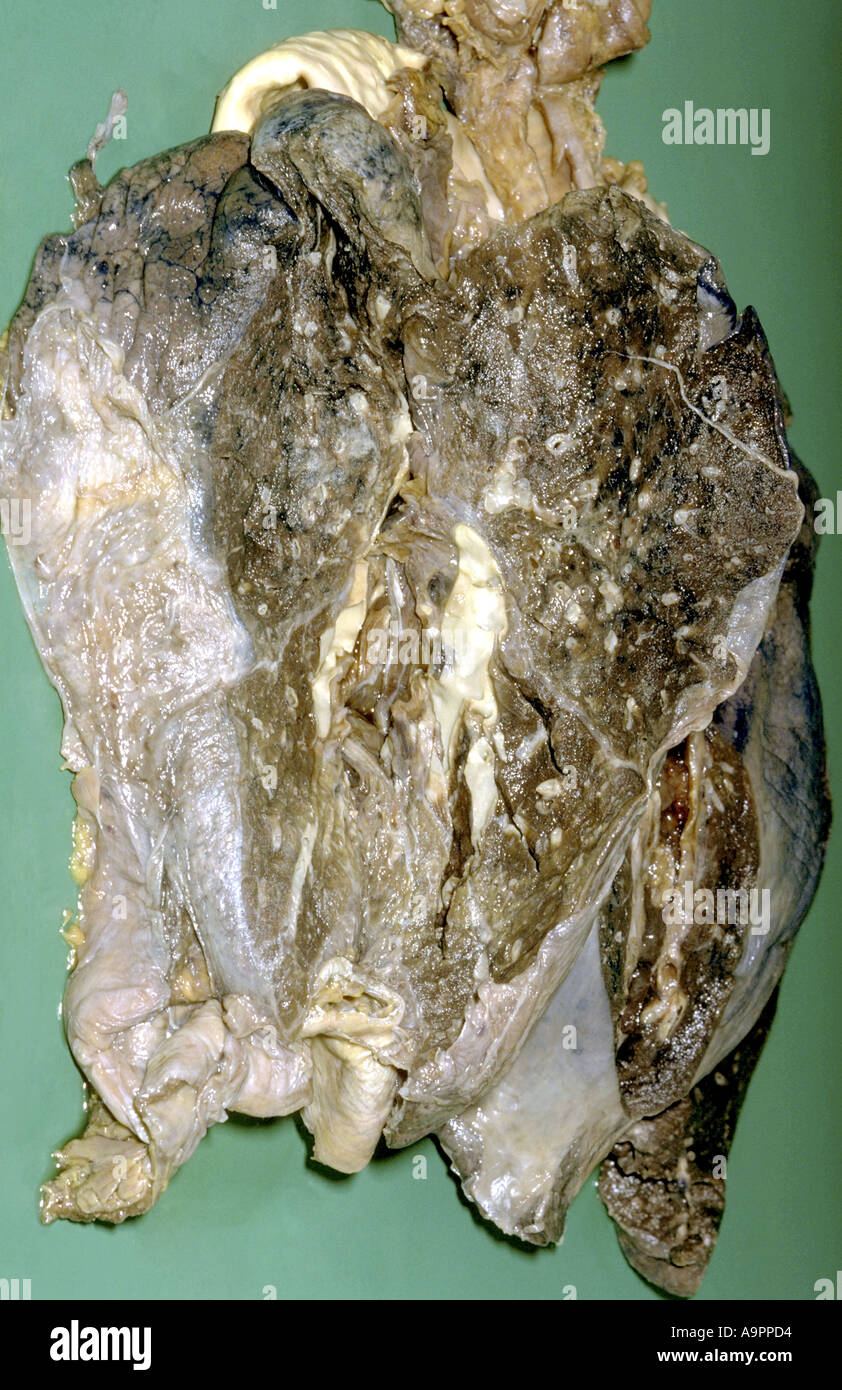Campione del polmone malattia polmonare interstiziale con enfisema e inferiore sinistra collasso del lobo Foto Stock